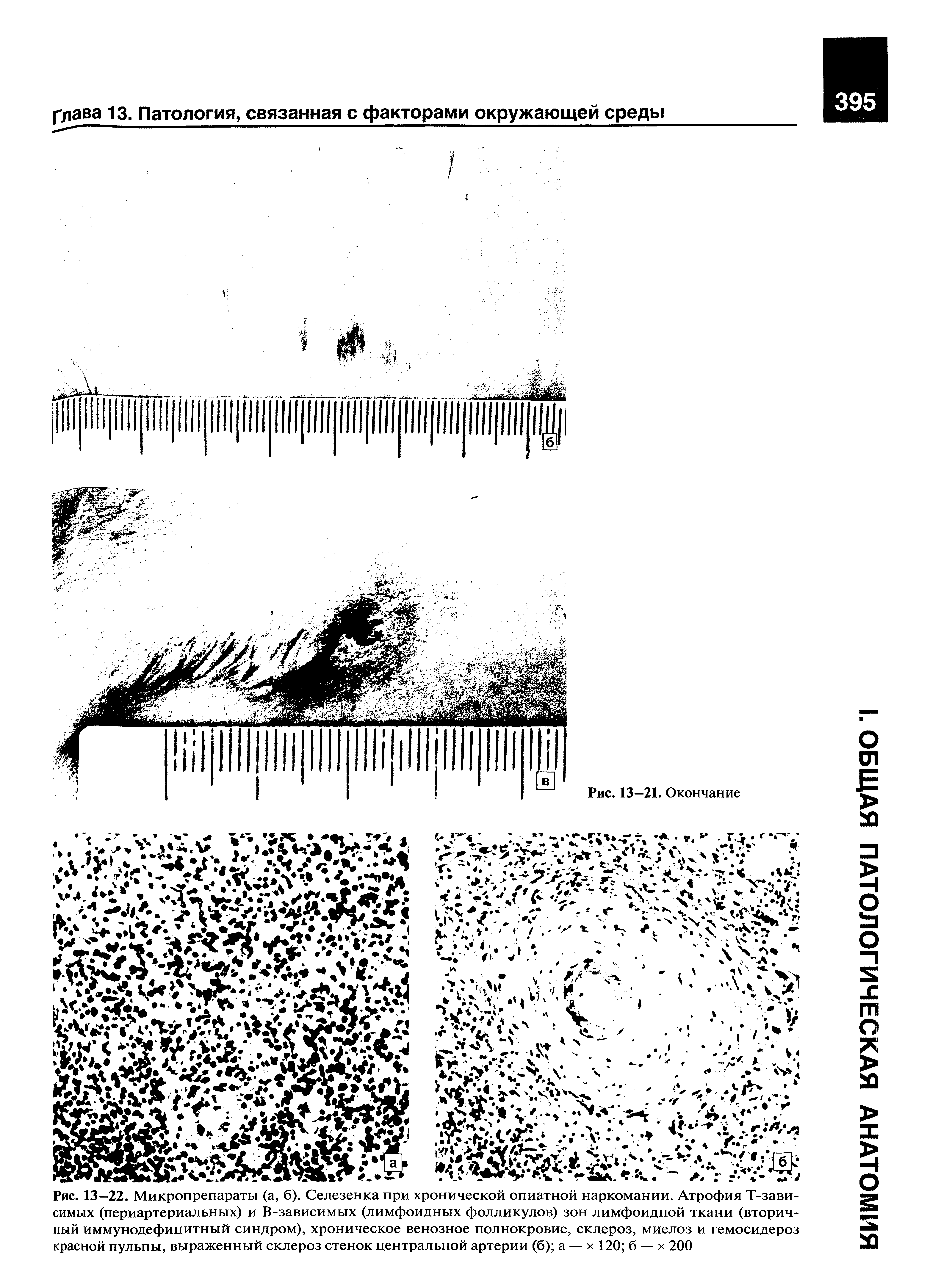 Рис. 13—22. Микропрепараты (а, б). Селезенка при хронической опиатной наркомании. Атрофия Т-зави-симых (периартериальных) и В-зависимых (лимфоидных фолликулов) зон лимфоидной ткани (вторичный иммунодефицитный синдром), хроническое венозное полнокровие, склероз, миелоз и гемосидероз красной пульпы, выраженный склероз стенок центральной артерии (б) а — х 120 б — х 200...