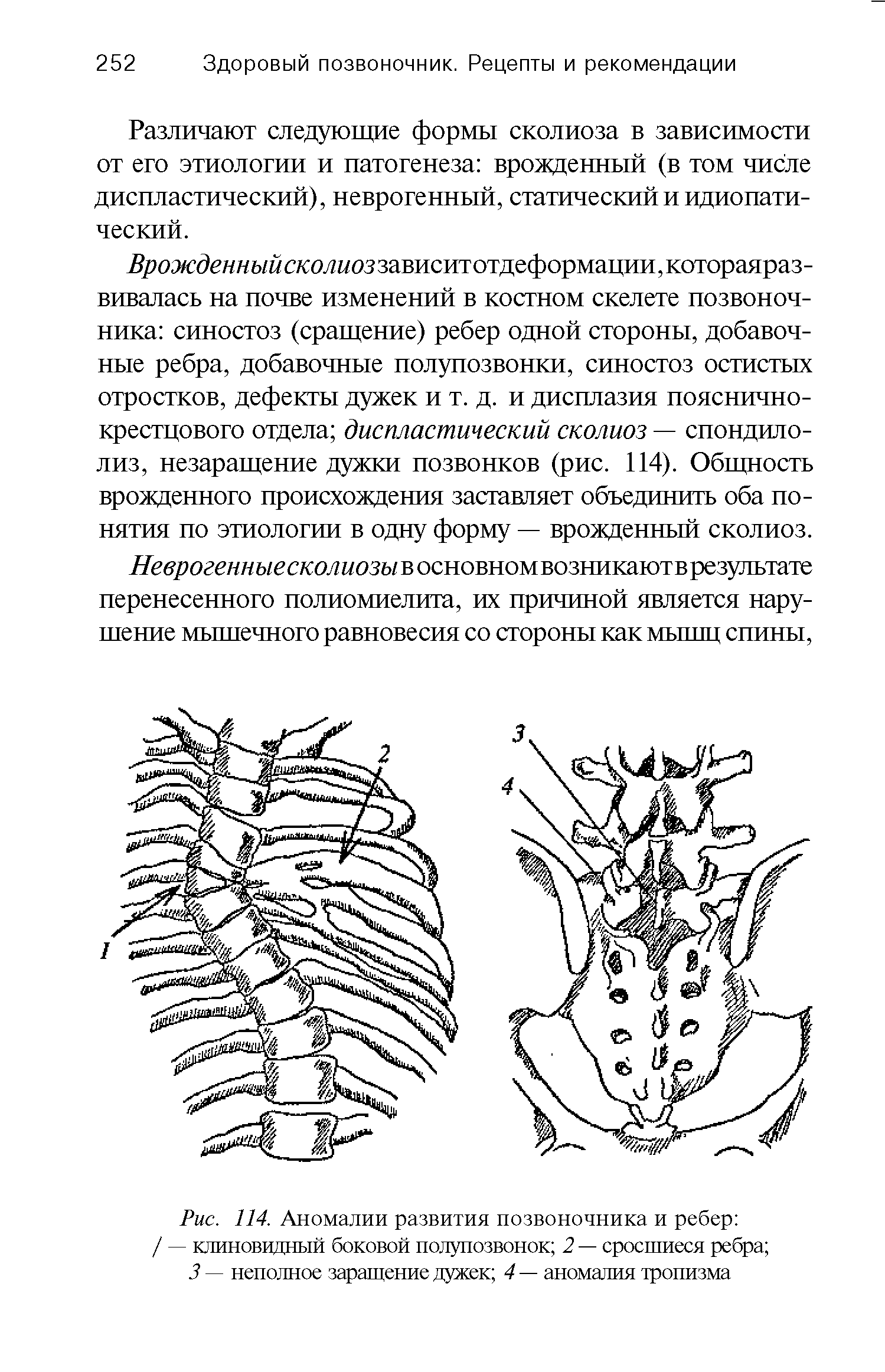 Рис. 114. Аномалии развития позвоночника и ребер / — клиновидный боковой полупозвонок 2 — сросшиеся ребра ...