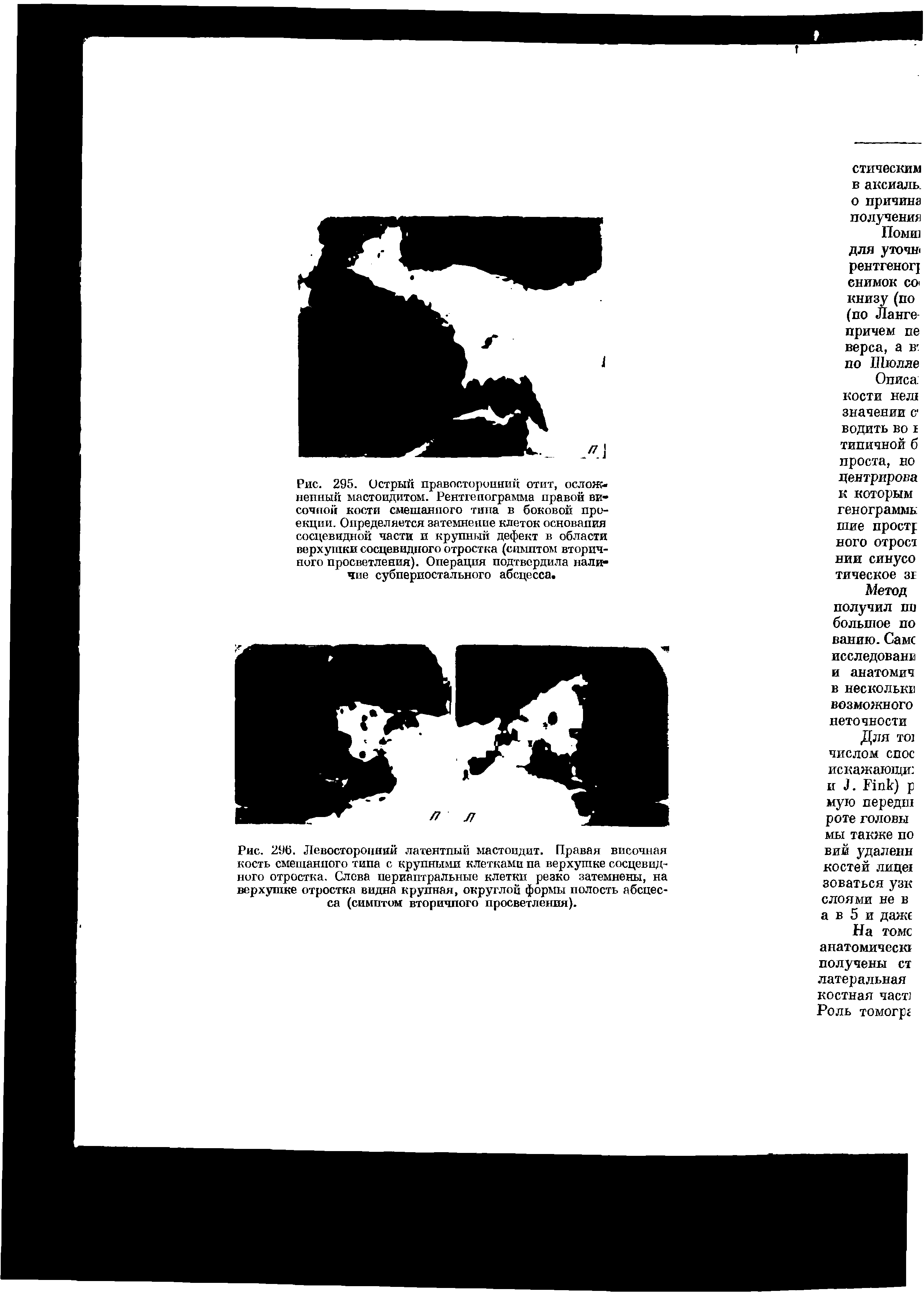 Рис. 296. Левосторонний латентный мастоидит. Правая височная кость смешанного типа с крупными клетками па верхушке сосцевидного отростка. Слева периаптральные клетки резко затемнены, на верхушке отростка видна крупная, округлой формы полость абсцесса (симптом вторичпого просветления).