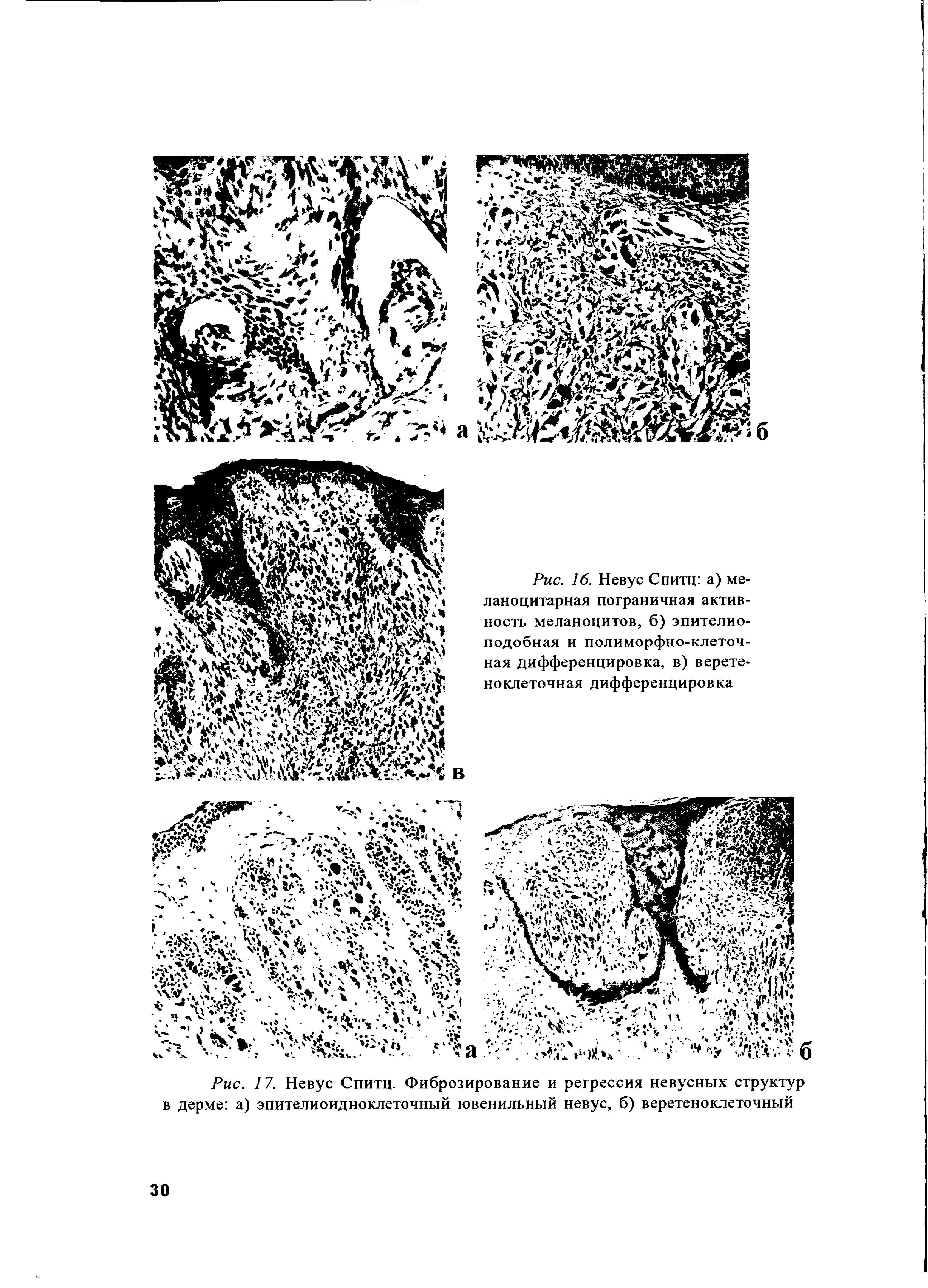 Рис. 17. Невус Спитц. Фиброзирование и регрессия невусных структур в дерме а) эпителиоидноклеточный ювенильный невус, б) веретеноклеточный...