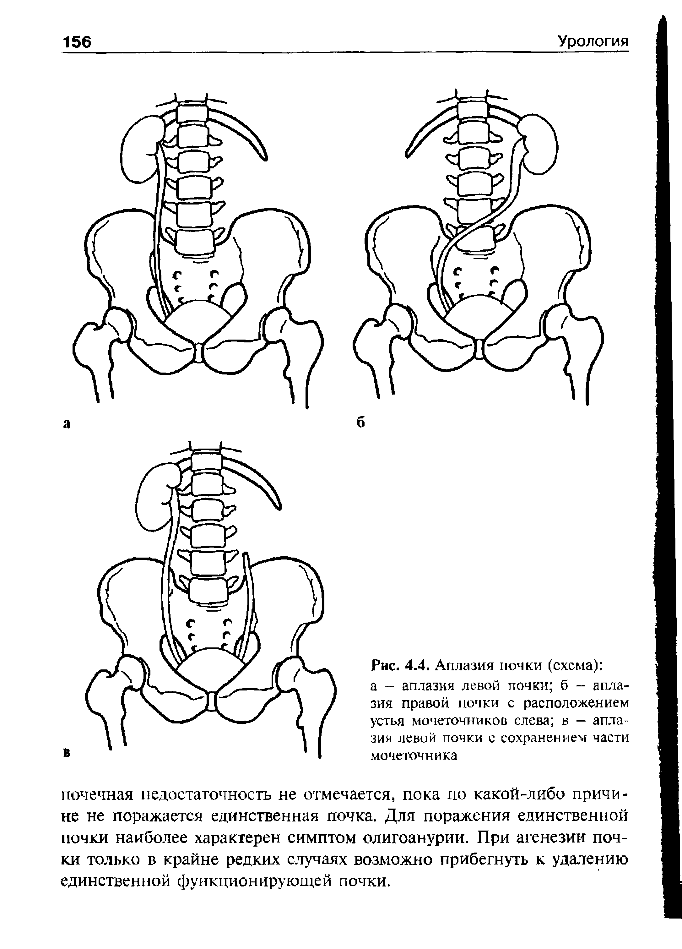 Рис. 4.4. Аплазия почки (схема) а — аплазия левой почки б — аплазия правой почки с расположением устья мочеточников слева в — аплазия левой почки с сохранением части мочеточника...