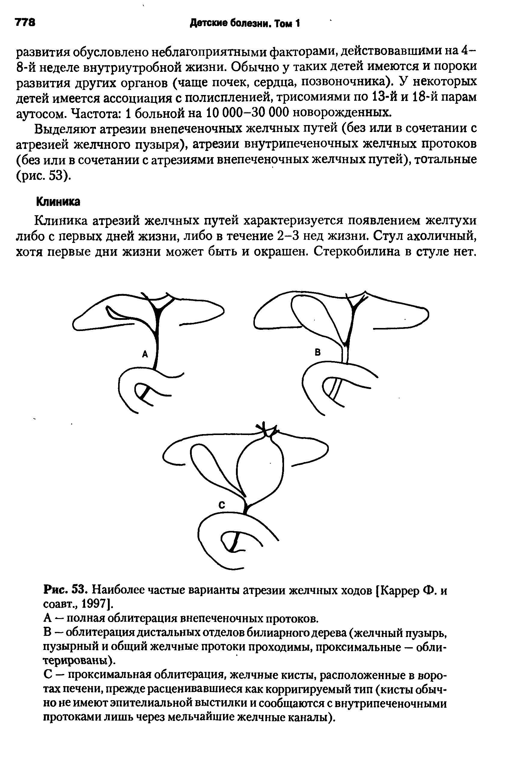 Рис. 53. Наиболее частые варианты атрезии желчных ходов [Каррер Ф. и соавт., 1997].