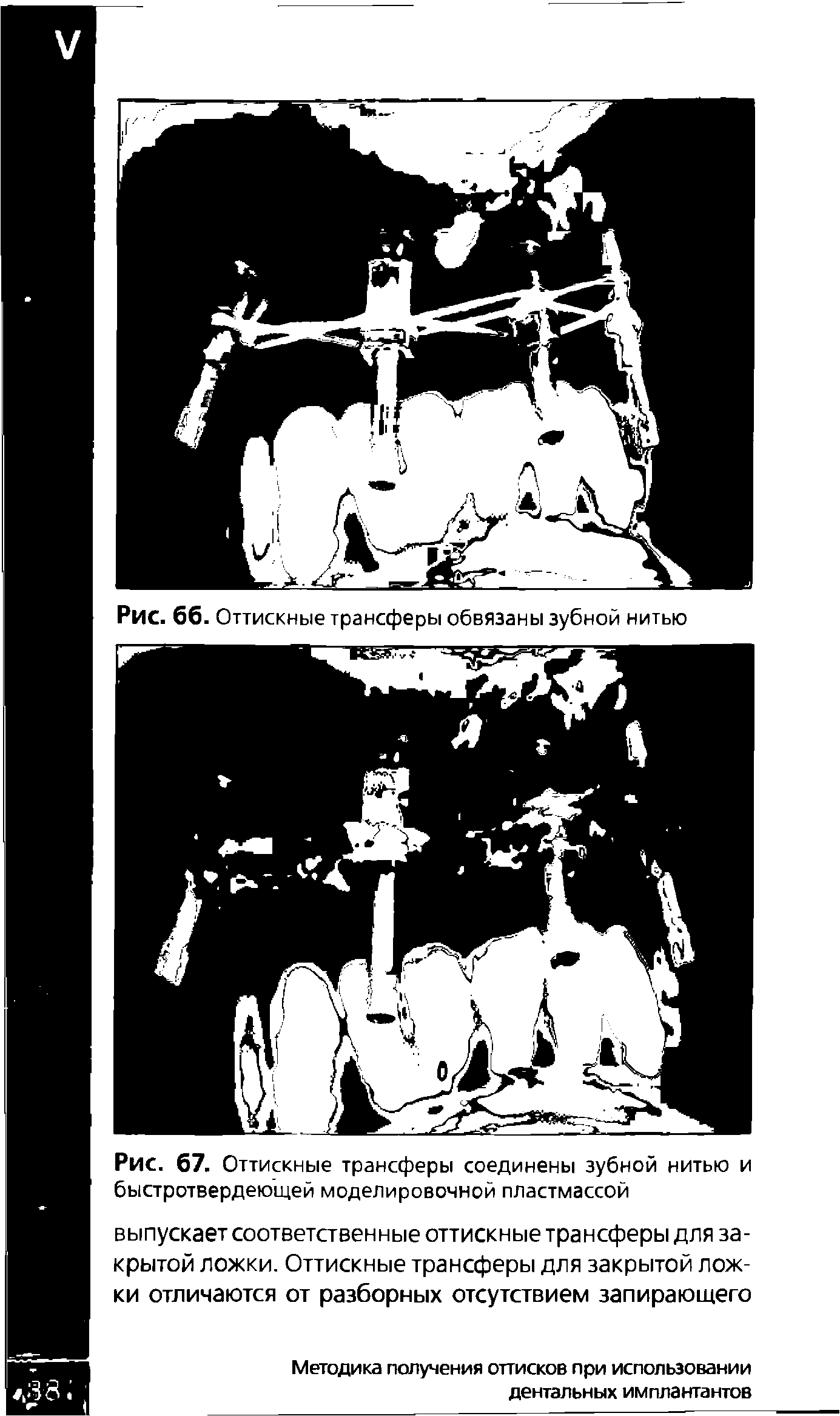 Рис. 67. Оттискные трансферы соединены зубной нитью и быстротвердеющей моделировочной пластмассой...
