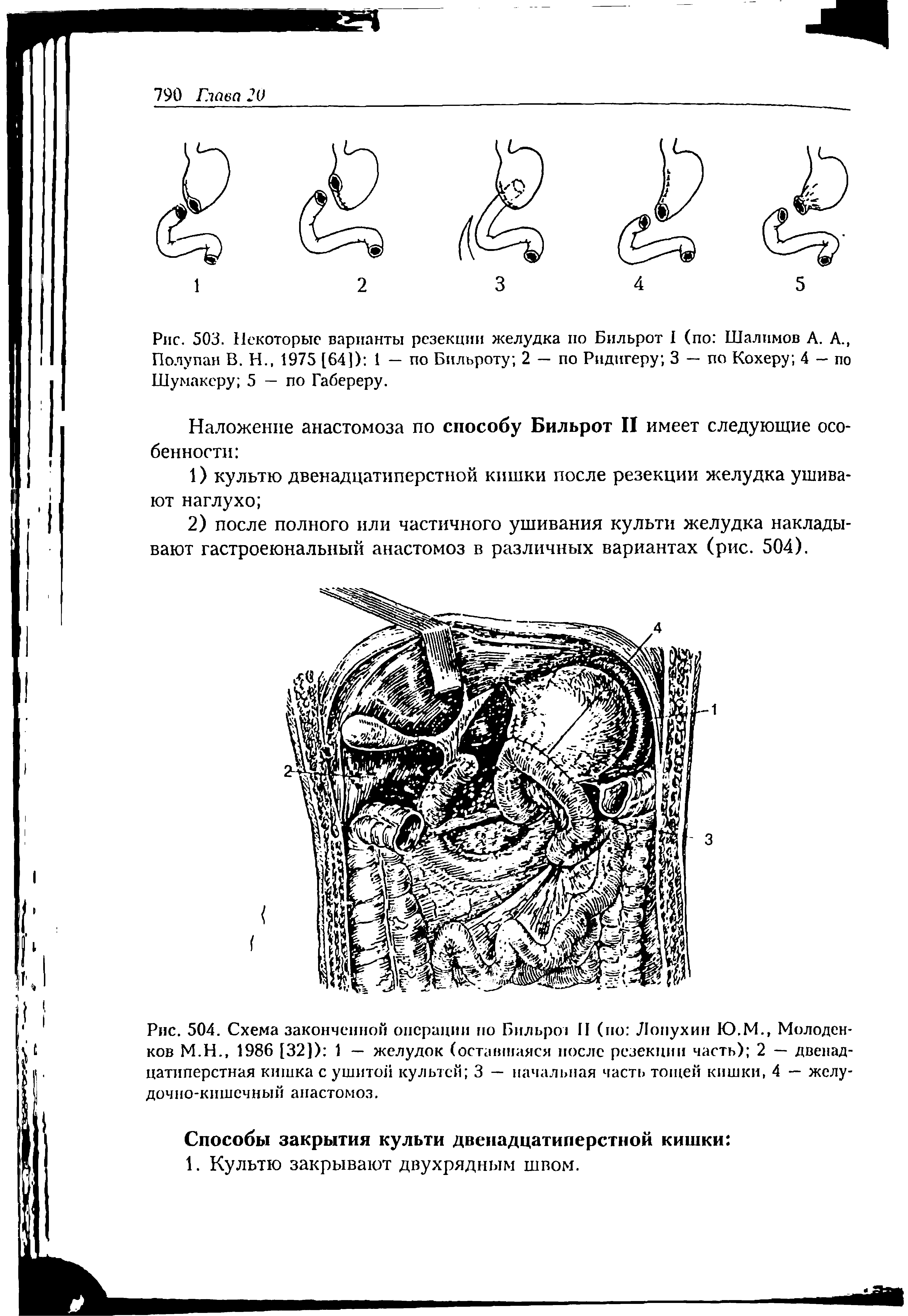 Рис. 503. Некоторые варианты резекции желудка по Бильрот I (по Шалимов А. А., Полу пан В. Н., 1975 [64]) 1 — по Бильроту 2 — по Ри дигеру 3 — по Кохеру 4 - по Шумакеру 5 — по Габереру.