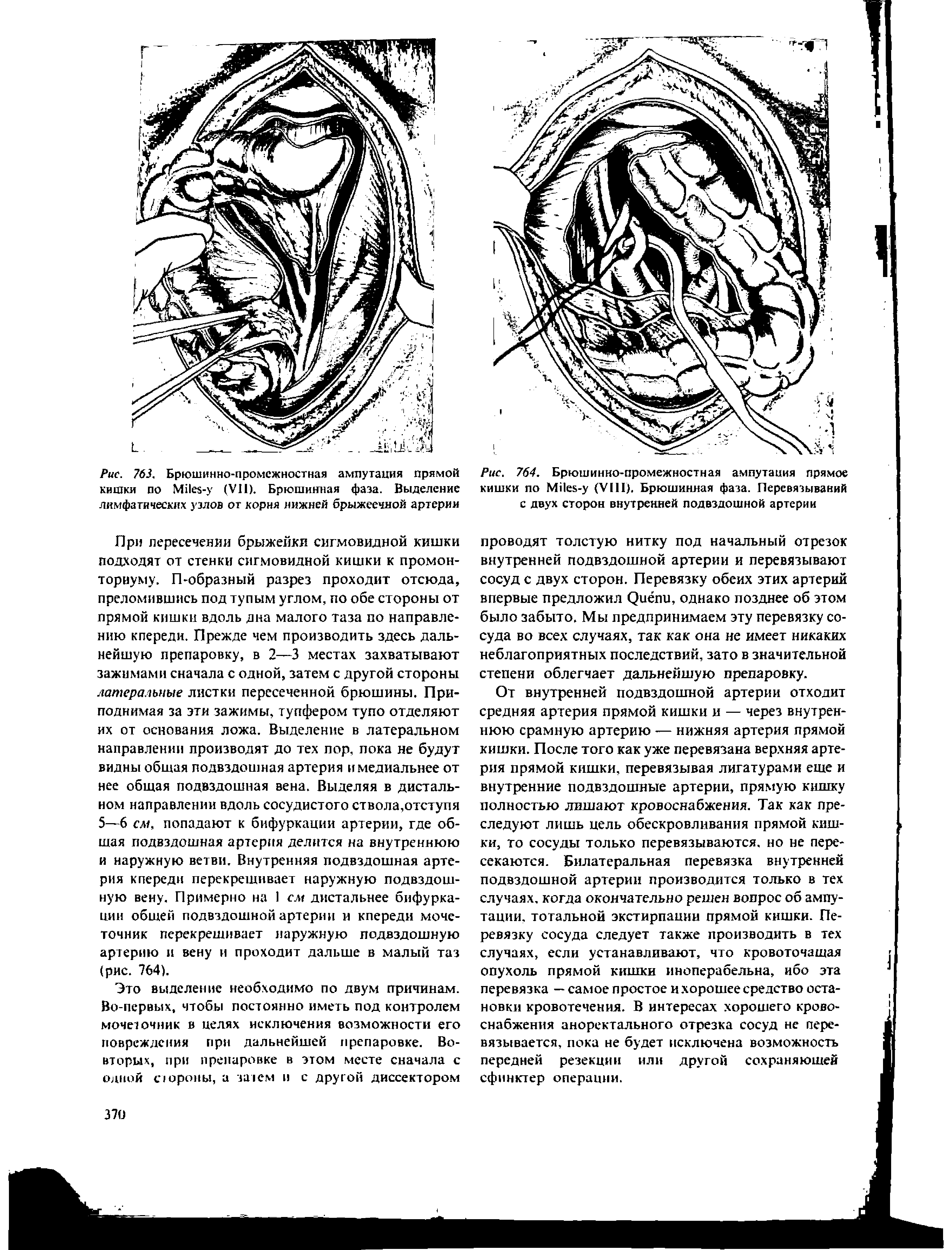 Рис. 764. Брюшинно-промежностная ампутация прямое кишки по M - (VIII). Брюшинная фаза. Перевязываний с двух сторон внутренней подвздошной артерии...