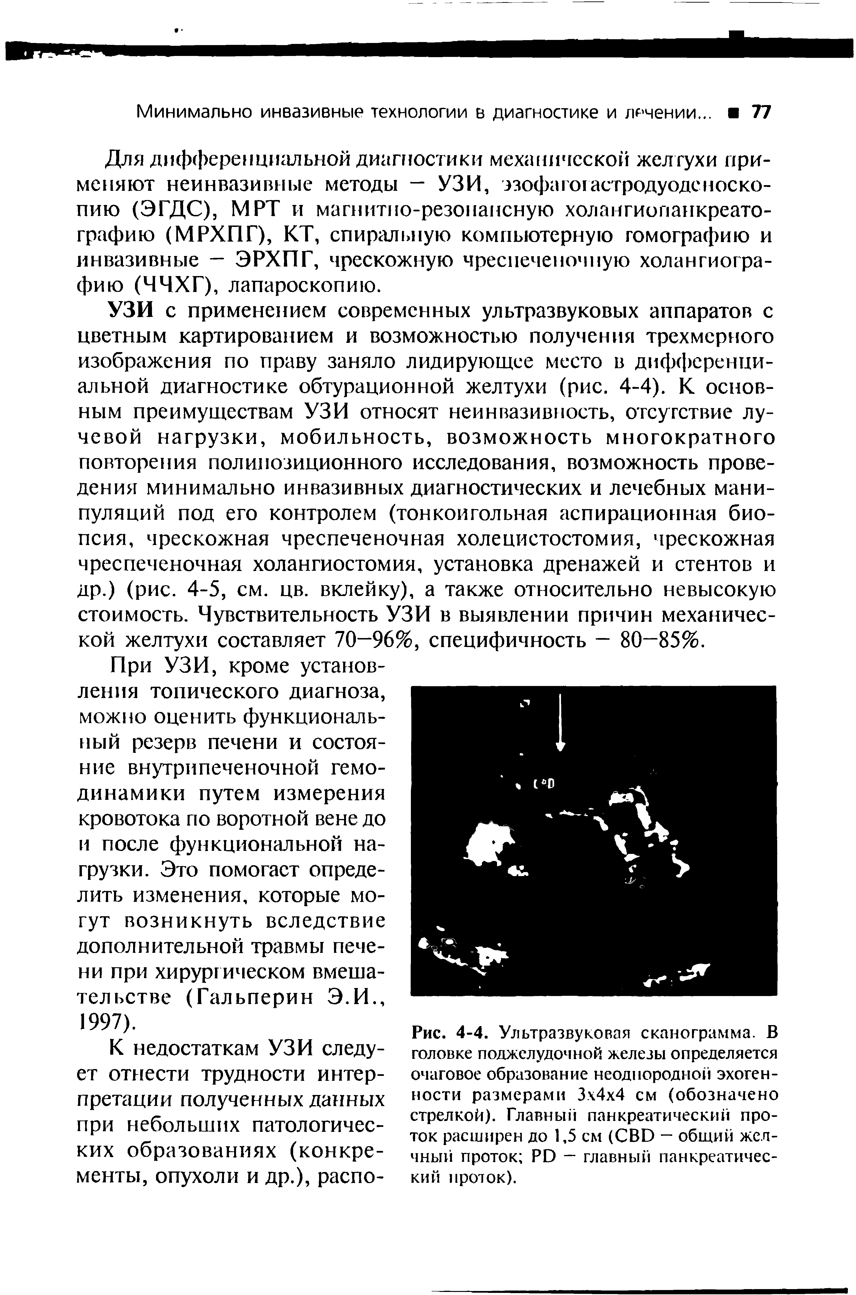 Рис. 4-4. Ультразвуковая сканограмма. В головке поджелудочной железы определяется очаговое образование неоднородной эхогенности размерами 3 4 4 см (обозначено стрелкой). Главный панкреатический проток расширен до 1,5 см (СВО — общий желчный проток РО — главный панкреатический проток).