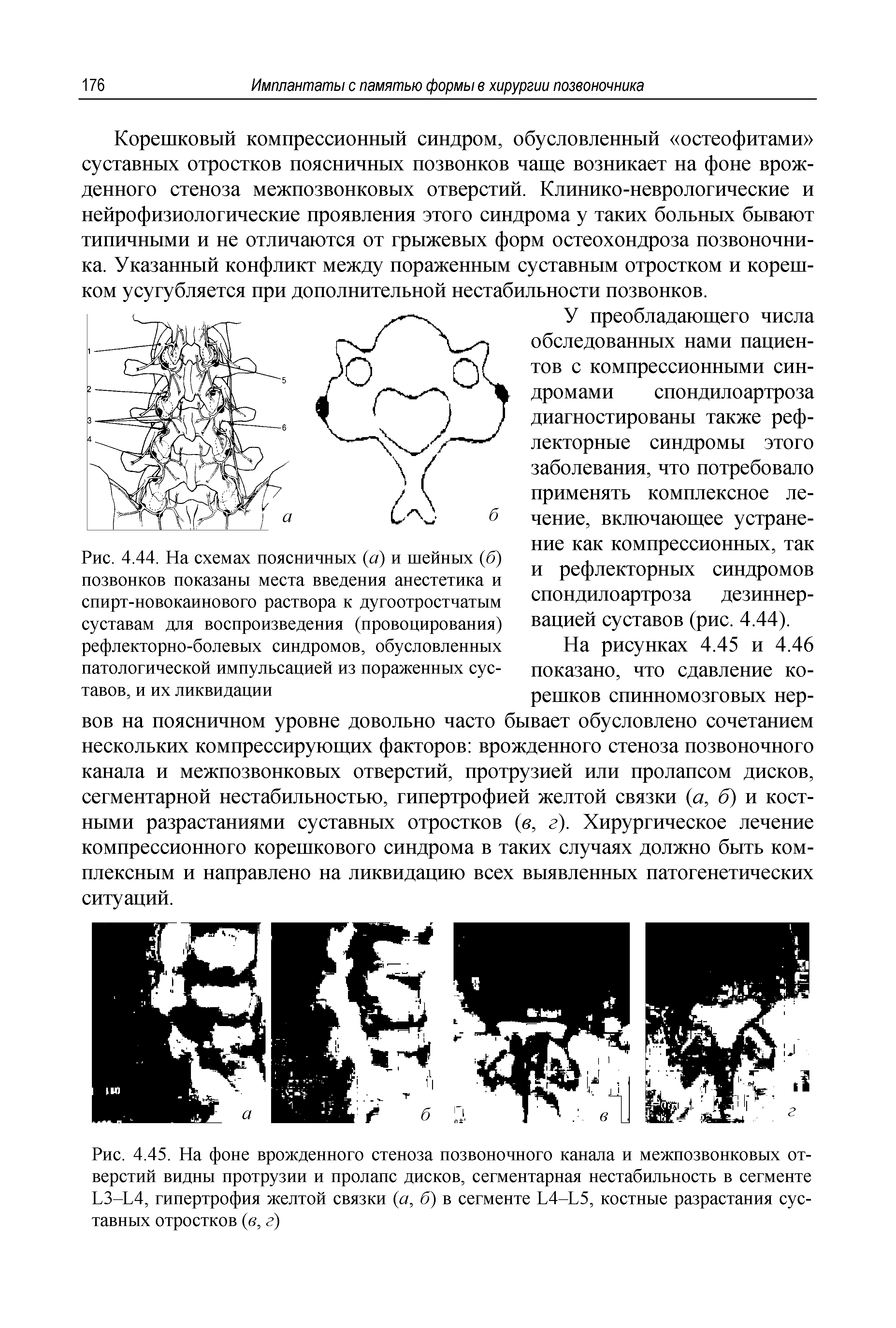 Рис. 4.44. На схемах поясничных (а) и шейных (б) позвонков показаны места введения анестетика и спирт-новокаинового раствора к дугоотростчатым суставам для воспроизведения (провоцирования) рефлекторно-болевых синдромов, обусловленных патологической импульсацией из пораженных сус-...