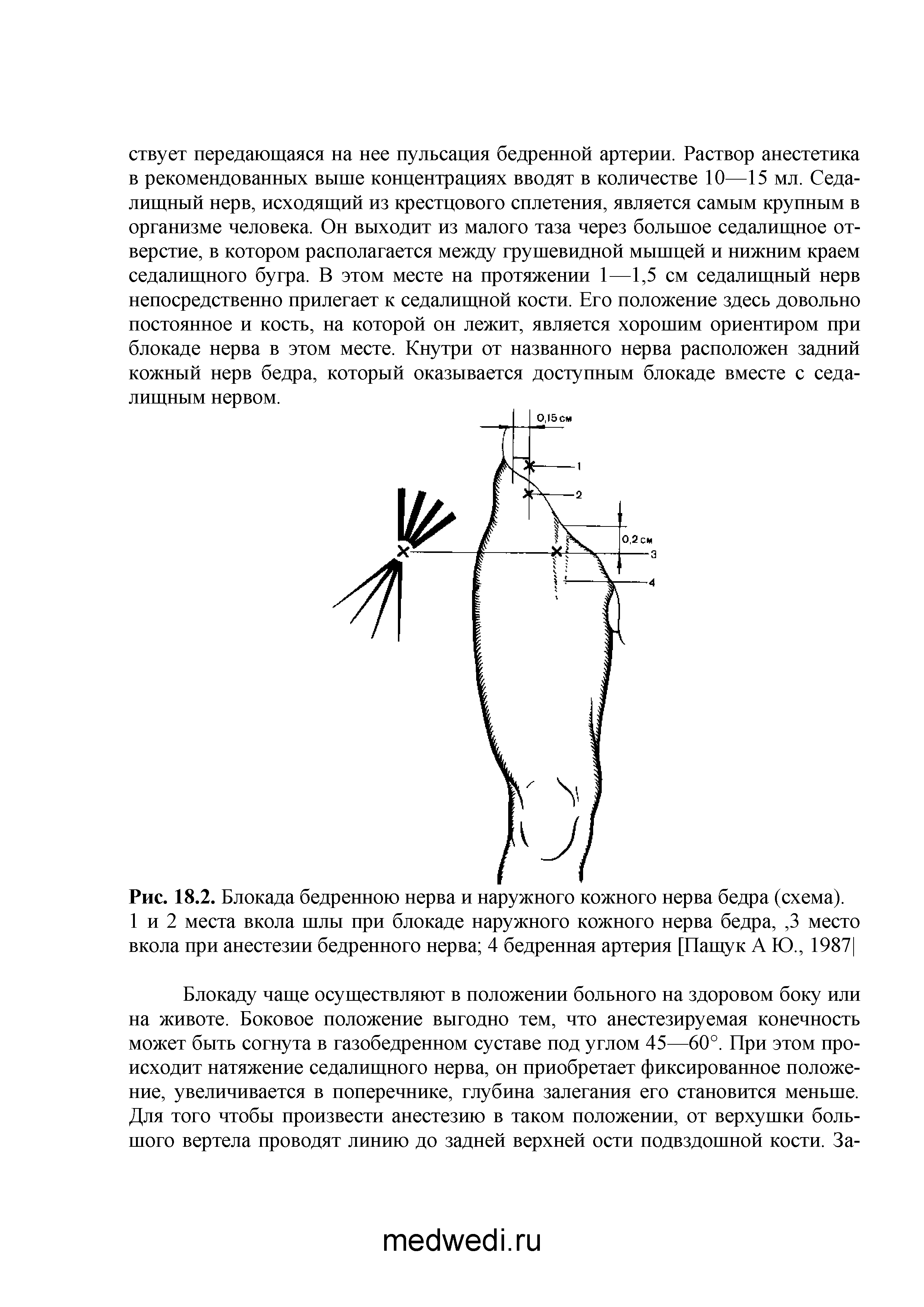Рис. 18.2. Блокада бедренною нерва и наружного кожного нерва бедра (схема). 1 и 2 места вкола шлы при блокаде наружного кожного нерва бедра,, 3 место вкола при анестезии бедренного нерва 4 бедренная артерия [Пашук А Ю., 1987]...