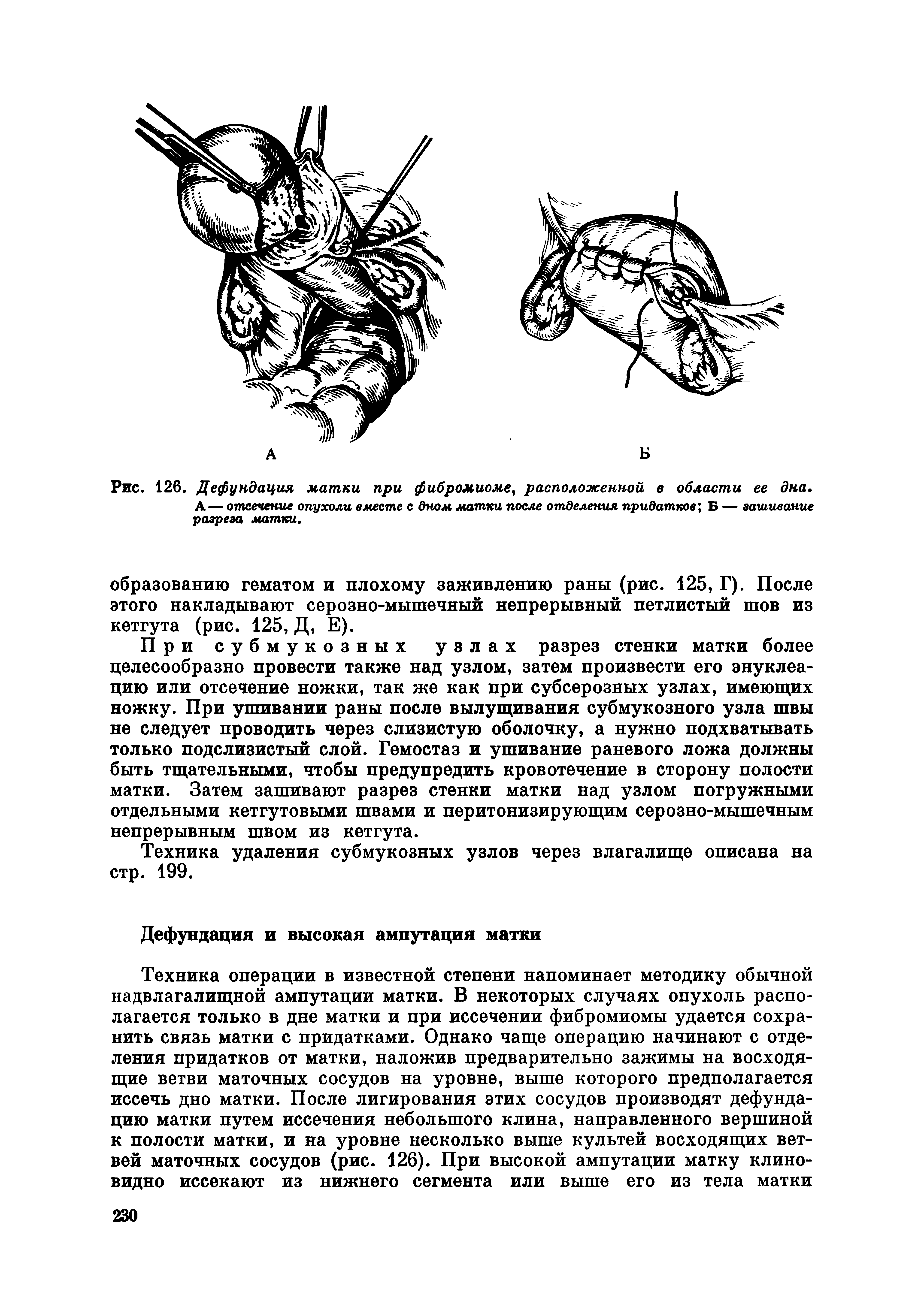 Рис. 126. Дефундация матки при фибромиоме, расположенной в области ее дна. А — отсечение опухоли вместе с дном матки после отделения придатков, Б — зашивание разреза матки.