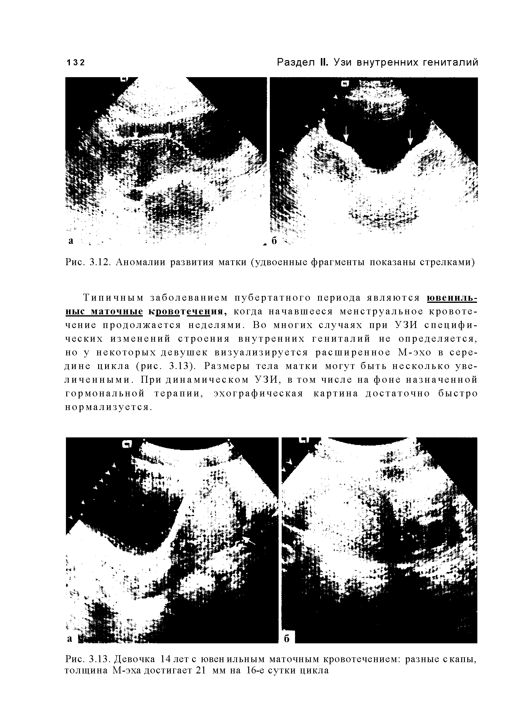 Рис. 3.12. Аномалии развития матки (удвоенные фрагменты показаны стрелками)...