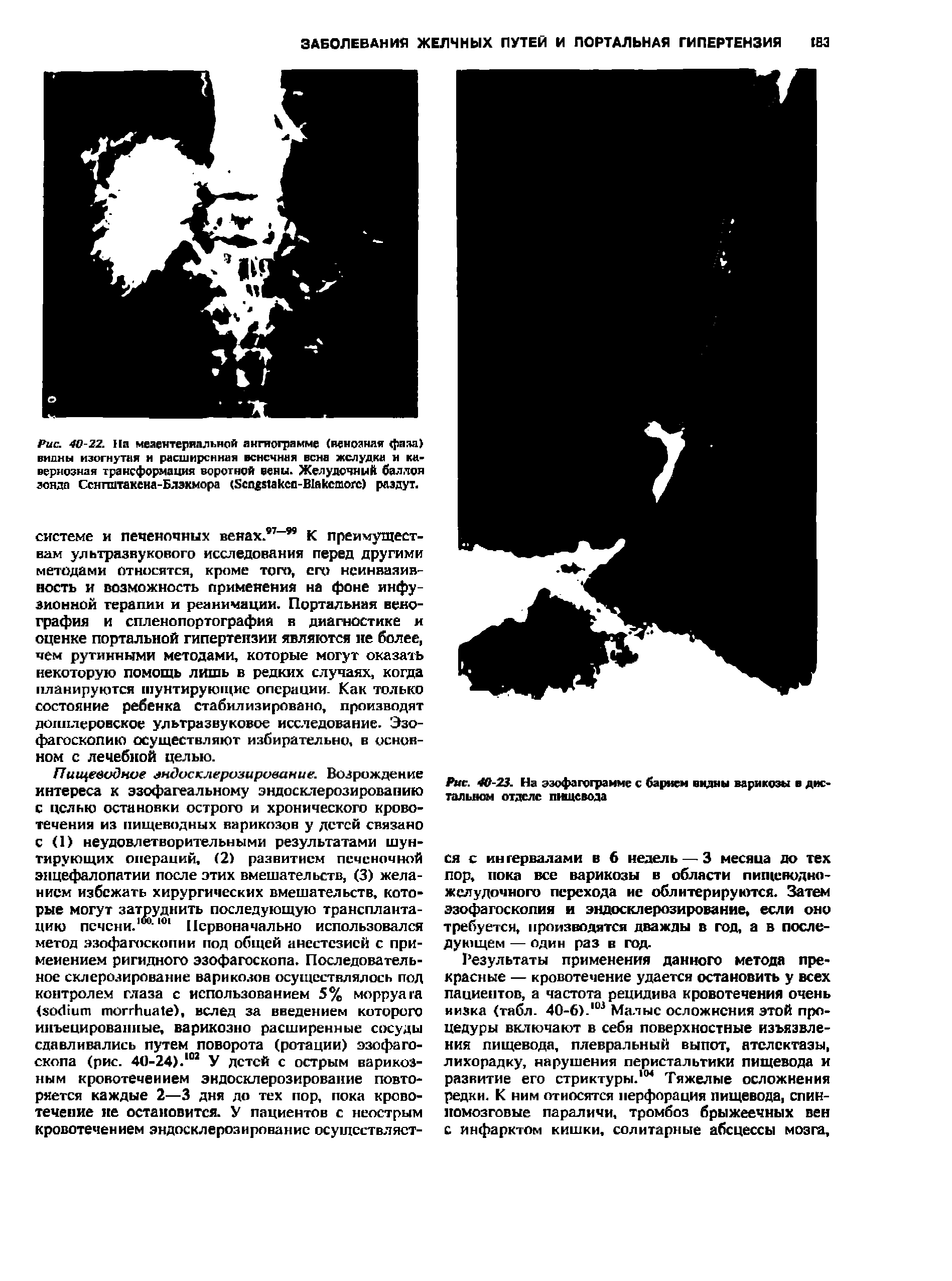 Рис. 40-23. На эзофаготрамме с барием видны варикозы В дне. талыюм отделе пищевода...