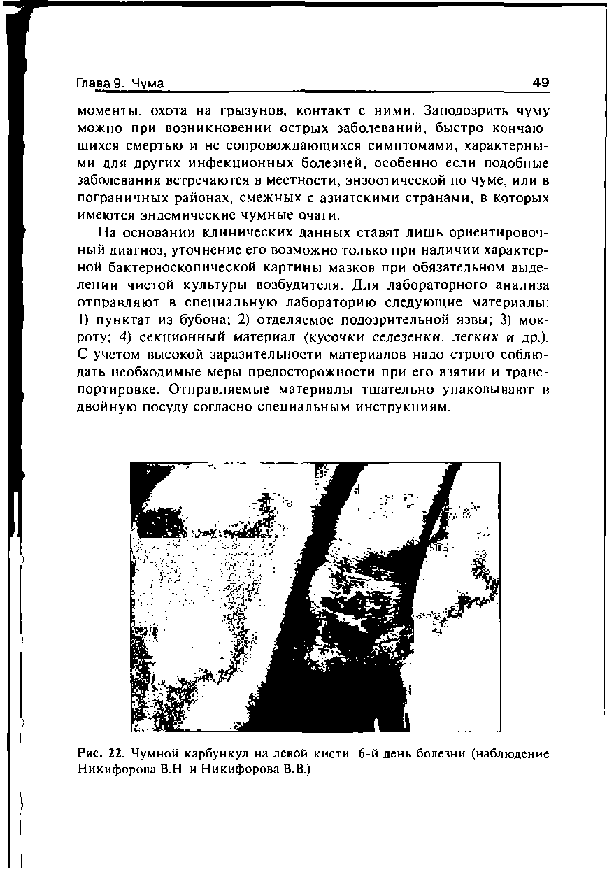 Рис. 22. Чумной карбункул на левой кисти 6-й день болезни (наблюдение Никифорова В.Н и Никифорова В.В.)...