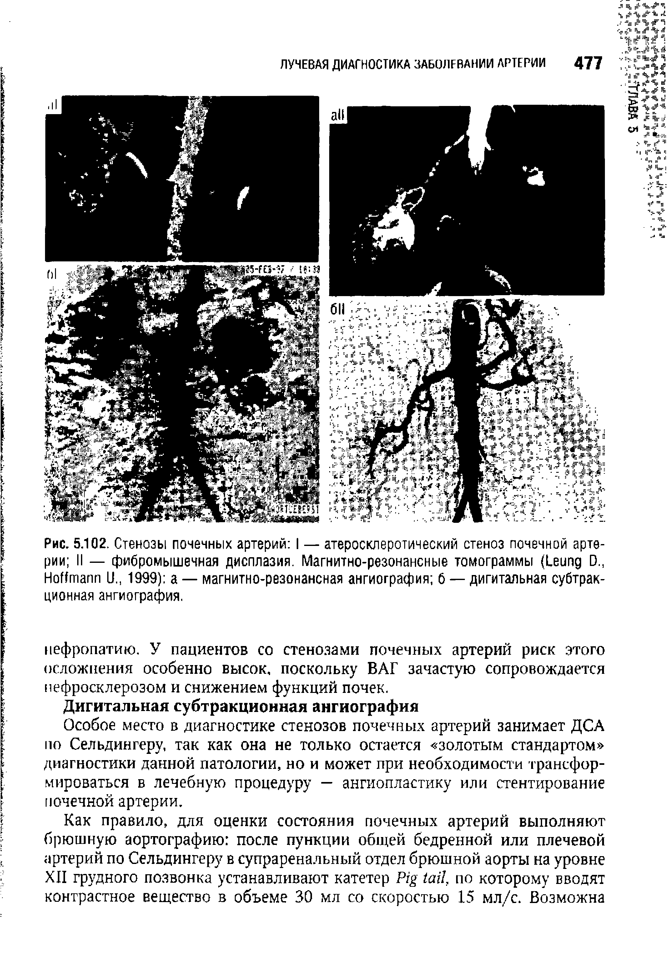 Рис. 5.102. Стенозы почечных артерий I — атеросклеротический стеноз почечной артерии II — фибромышечная дисплазия. Магнитно-резонансные томограммы (L D., H U., 1999) а — магнитно-резонансная ангиография б — дигитальная субтракционная ангиография.