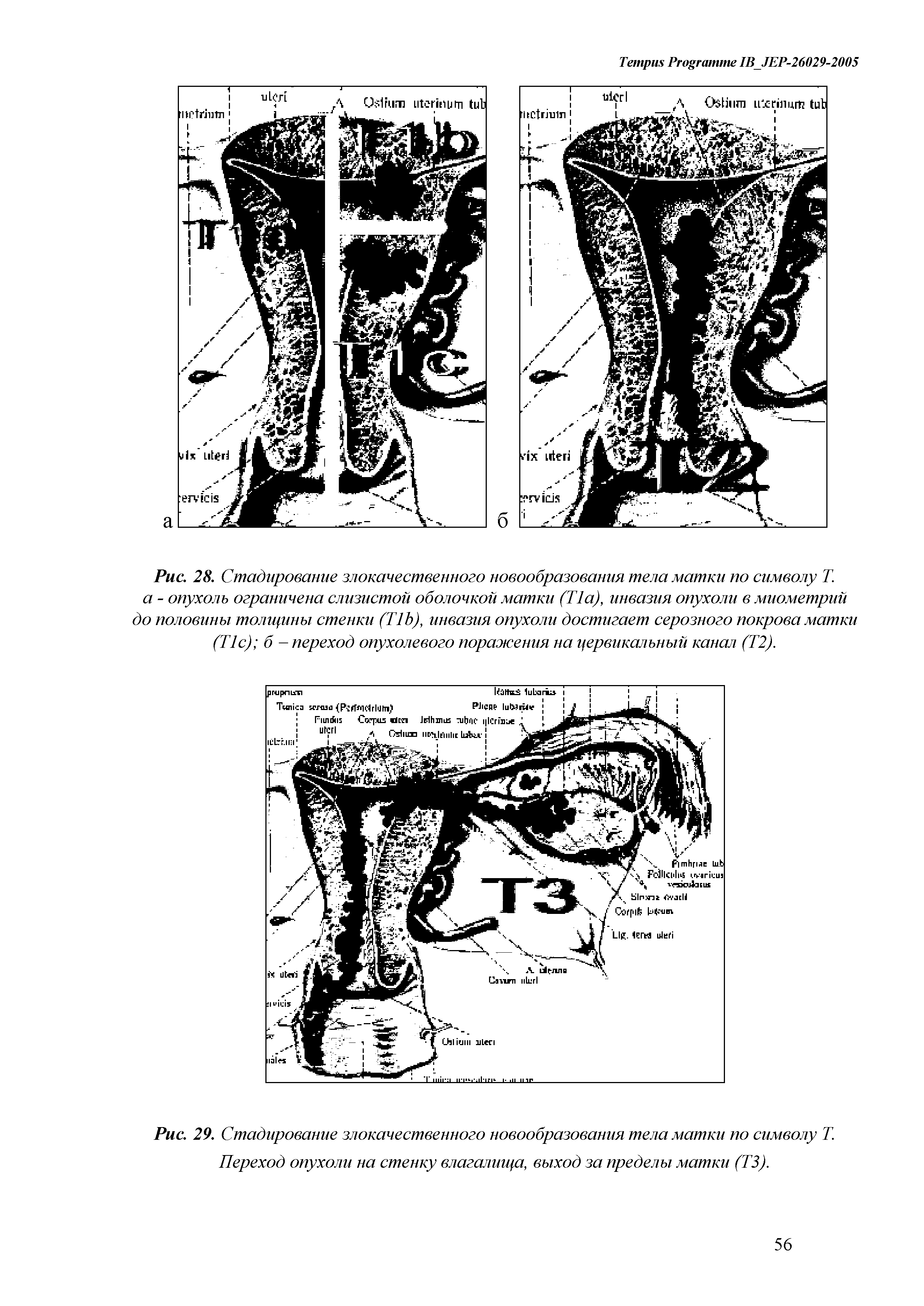 Рис. 28. Стадирование злокачественного новообразования тела матки по символу Т. а - опухоль ограничена слизистой оболочкой матки (Т1а), инвазия опухоли в миометрий до половины толщины стенки (T ), инвазия опухоли достигает серозного покрова матки (T ) б - переход опухолевого поражения на цервикальный канал (Т2).