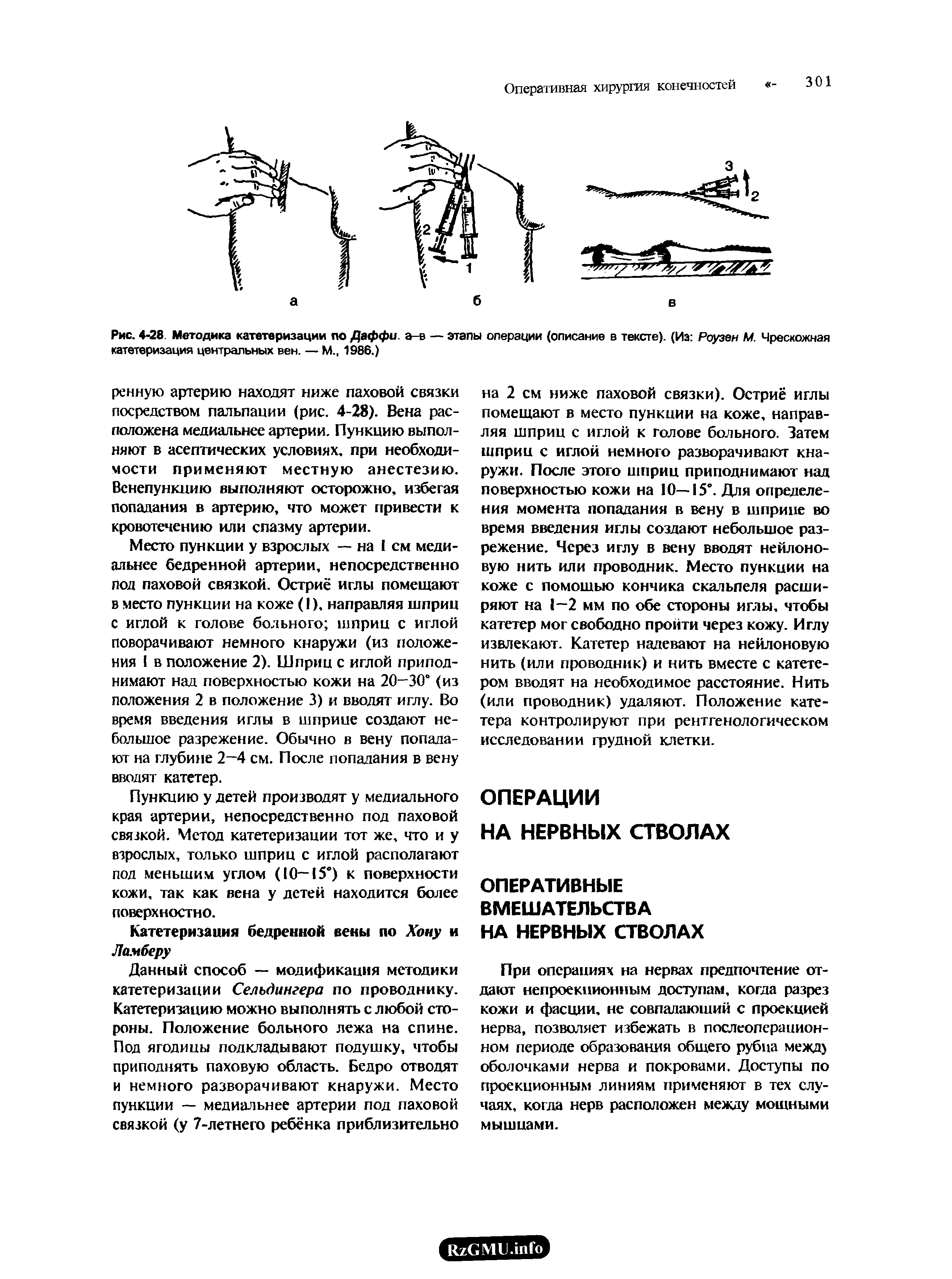 Рис. 4-28 Методика катетеризации по Даффи, а-в — этапы операции (описание в тексте). (Из Роузен М. Чрескожная катетеризация центральных вен. — М., 1986.)...