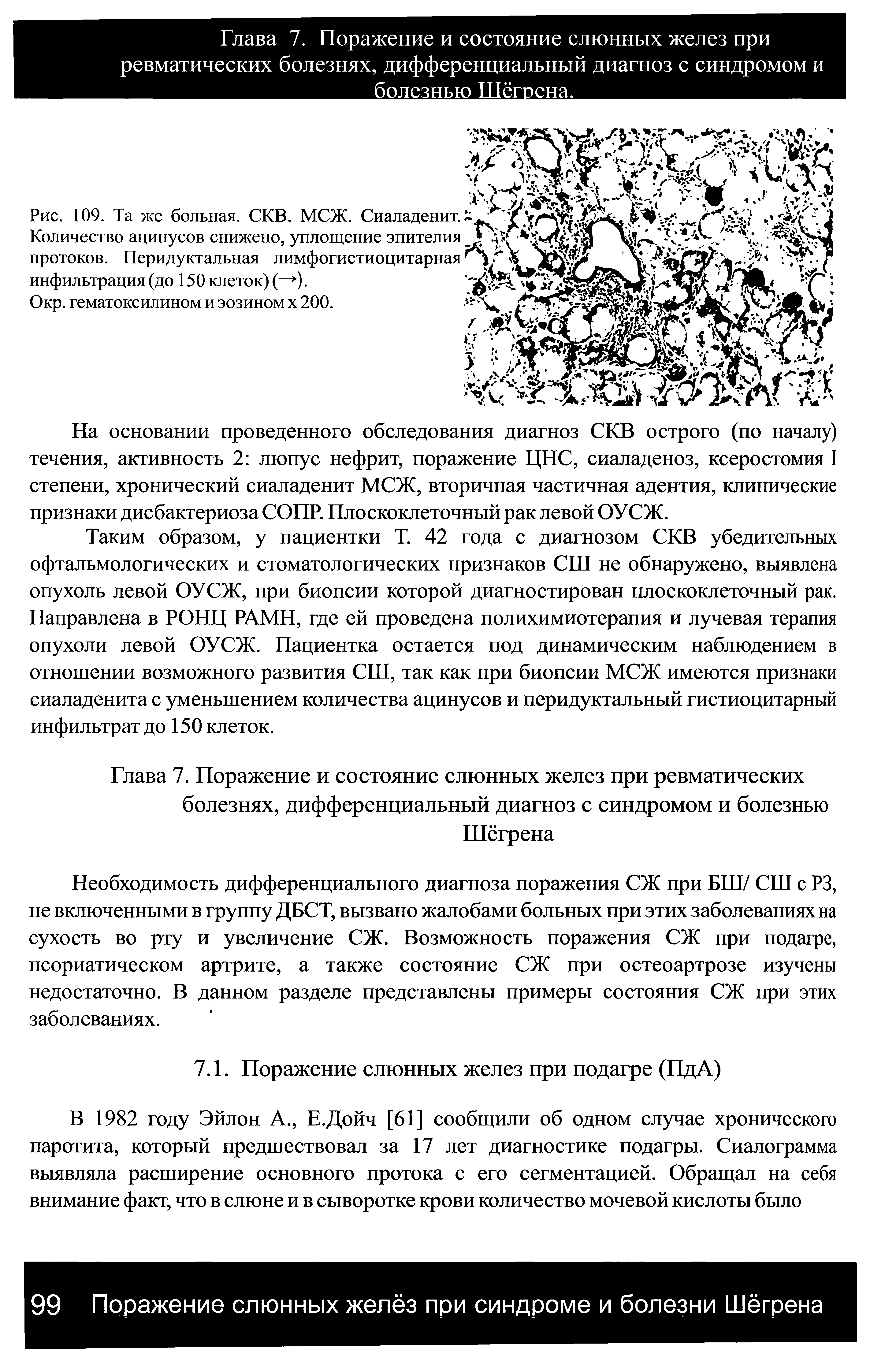 Рис. 109. Та же больная. СКВ. МСЖ. Сиаладенит. X Количество ацинусов снижено, уплощение эпителия протоков. Перидуктальная лимфогистиоцитарная инфильтрация (до 150 клеток) (— ).