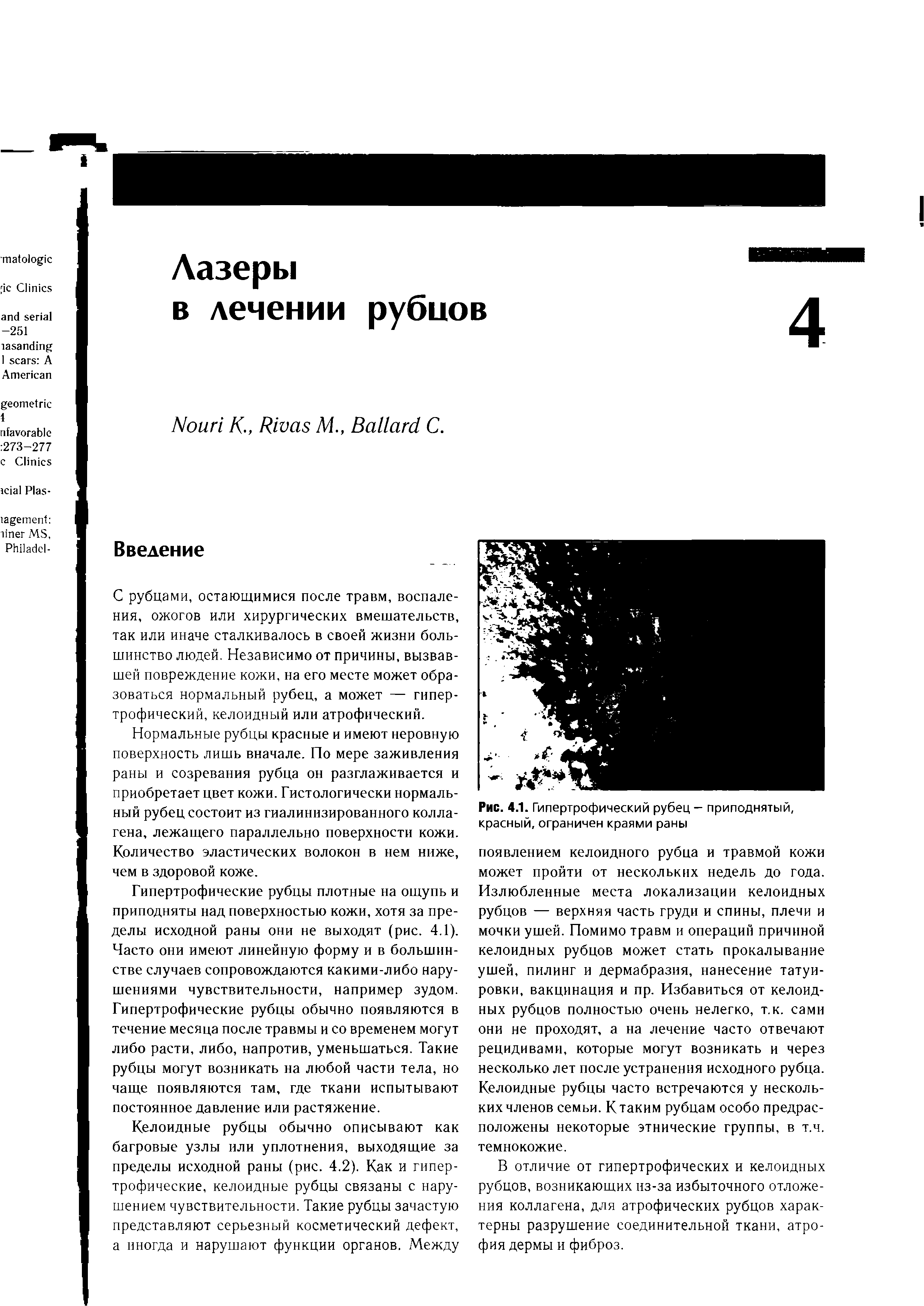 Рис. 4.1. Гипертрофический рубец — приподнятый, красный, ограничен краями раны...