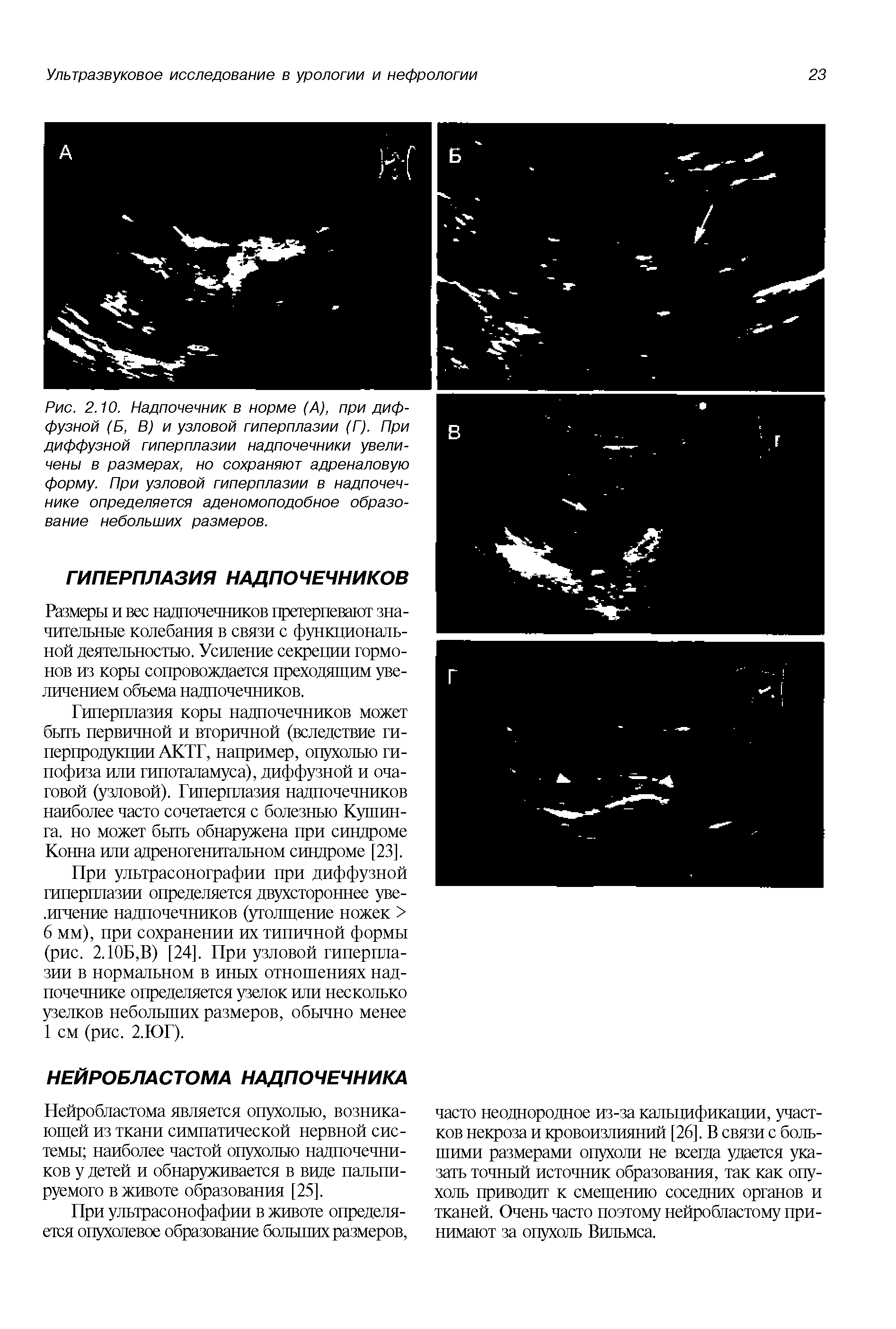 Рис. 2.10. Надпочечник в норме (А), при диффузной (Б, В) и узловой гиперплазии (Г). При диффузной гиперплазии надпочечники увеличены в размерах, но сохраняют адреналовую форму. При узловой гиперплазии в надпочечнике определяется аденомоподобное образование небольших размеров.