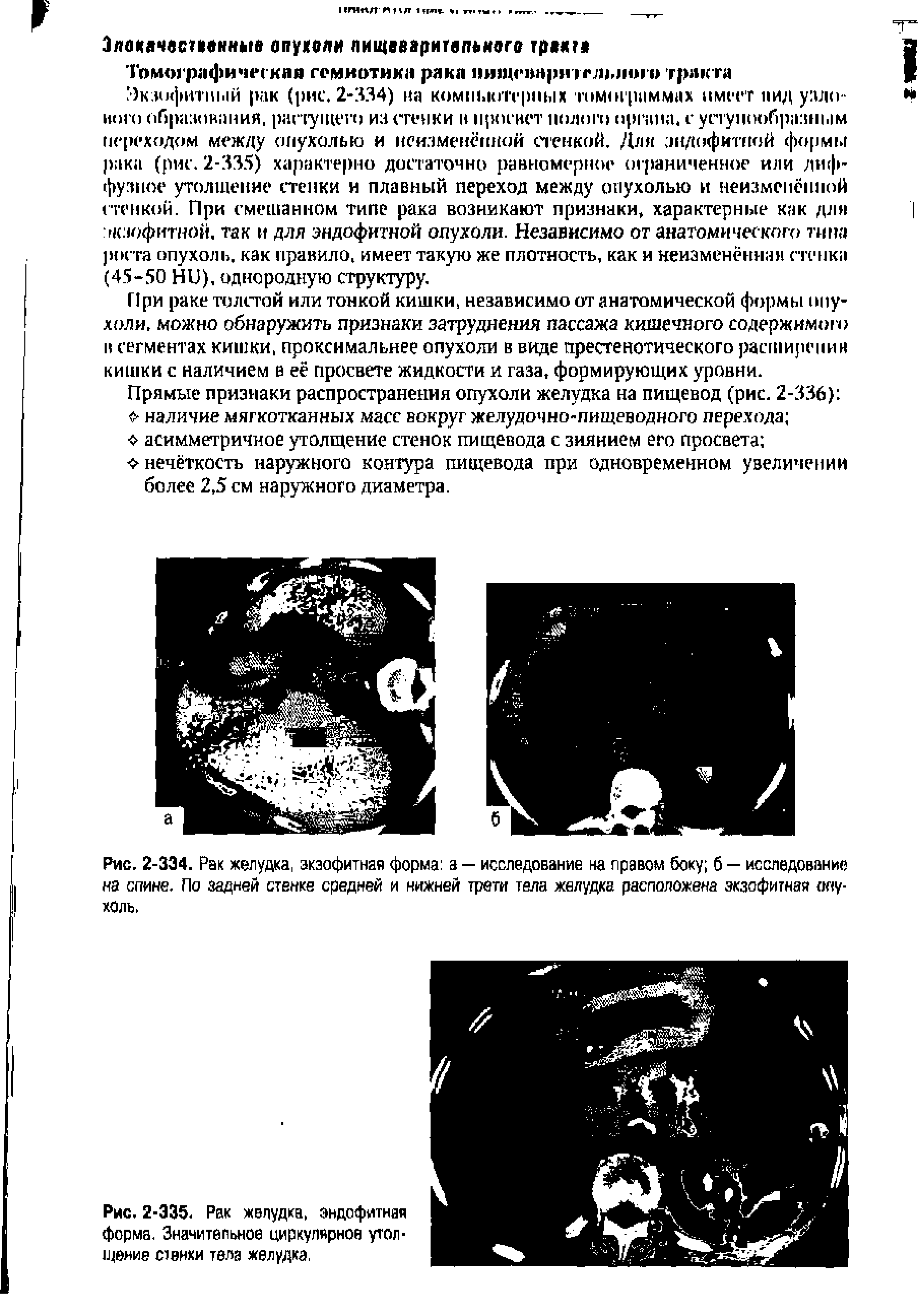 Рис. 2-334. Рак желудка, экзофитная форма а — исследование на правом боку б — исследование на спине. По задней стенке средней и нижней трети тела желудка расположена экзофитная опухоль.