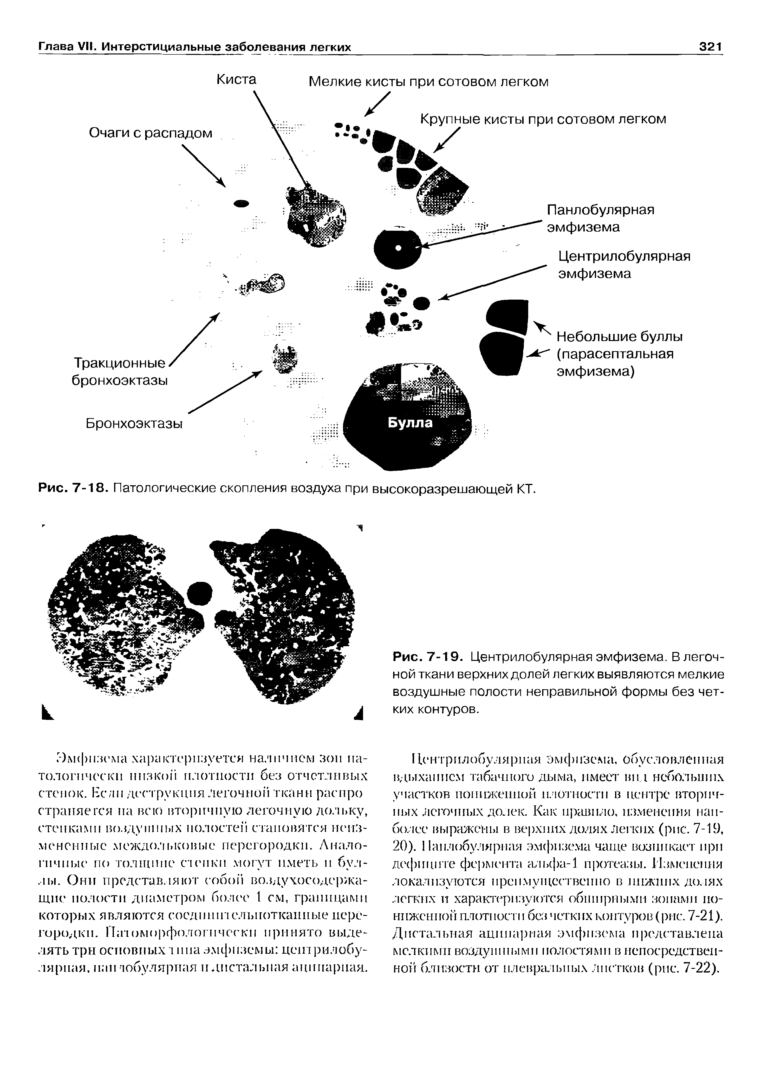 Рис. 7-19. Центрилобулярная эмфизема. В легочной ткани верхних долей легких выявляются мелкие воздушные полости неправильной формы без четких контуров.