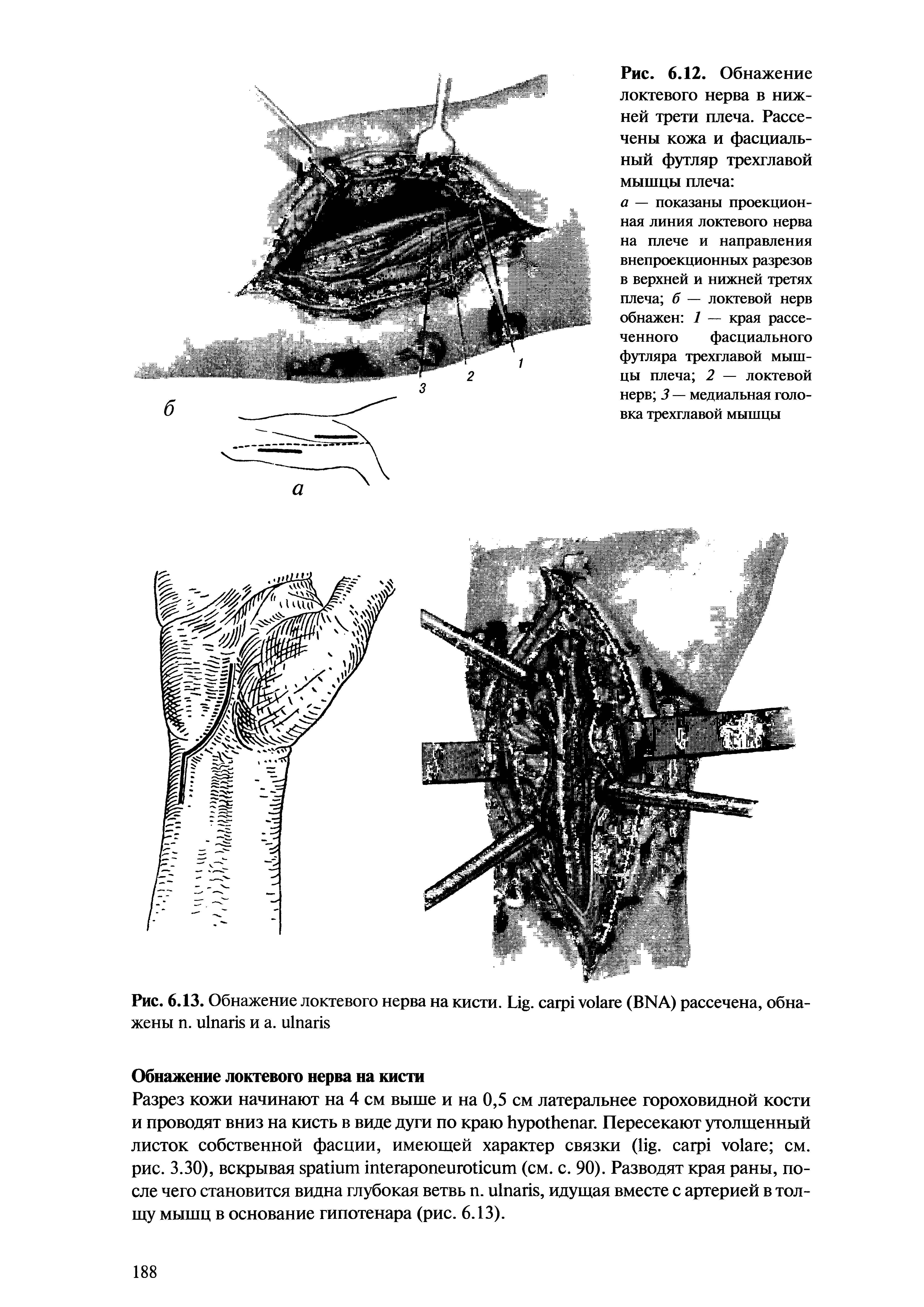 Рис. 6.13. Обнажение локтевого нерва на кисти. L . (BNА) рассечена, обнажены . и . ...