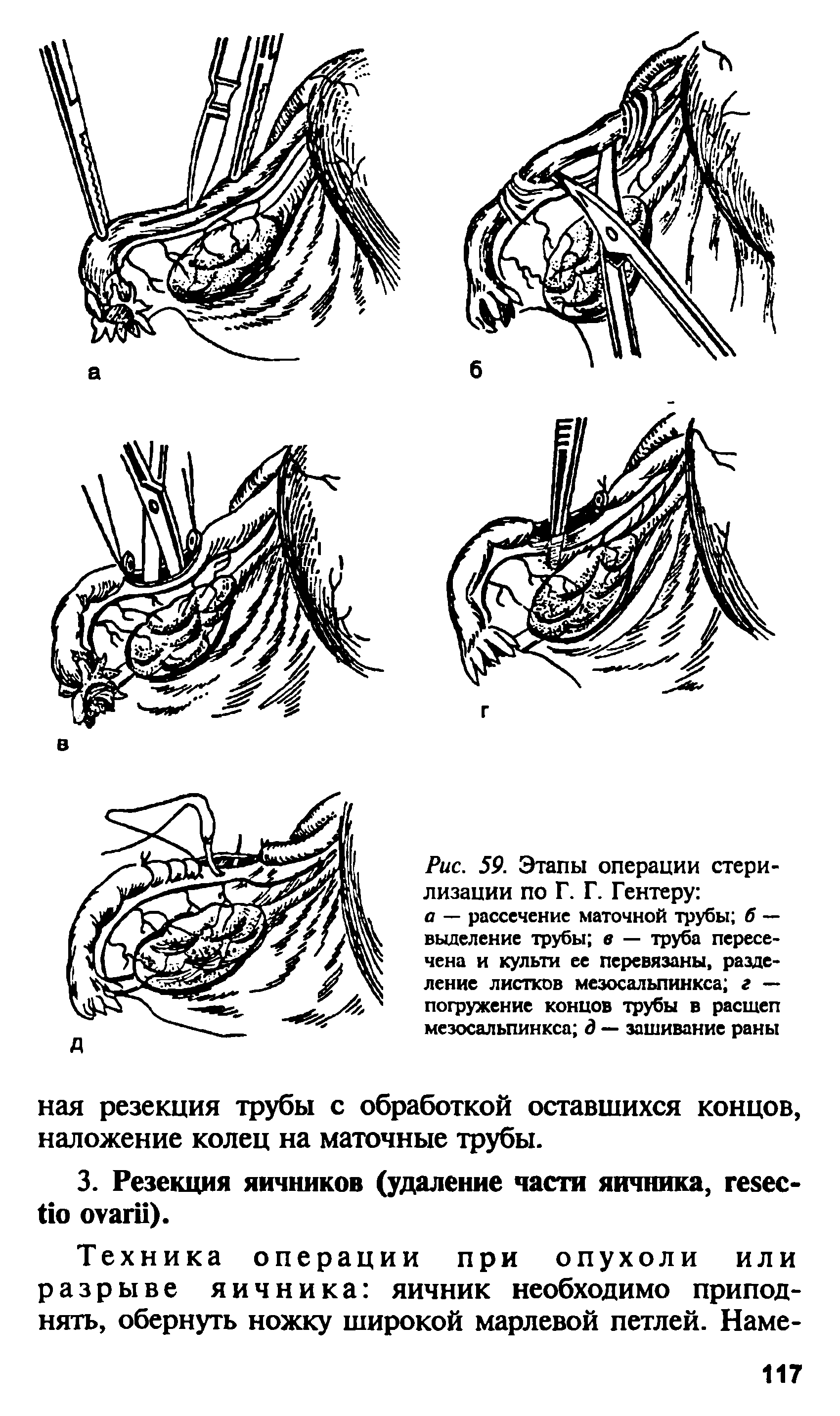 Рис. 59. Этапы операции стерилизации по Г. Г. Гентеру а — рассечение маточной трубы б — выделение трубы в — труба пересечена и культи ее перевязаны, разделение листков мезосальпинкса г — погружение концов трубы в расщеп мезосальпинкса д — зашивание раны...