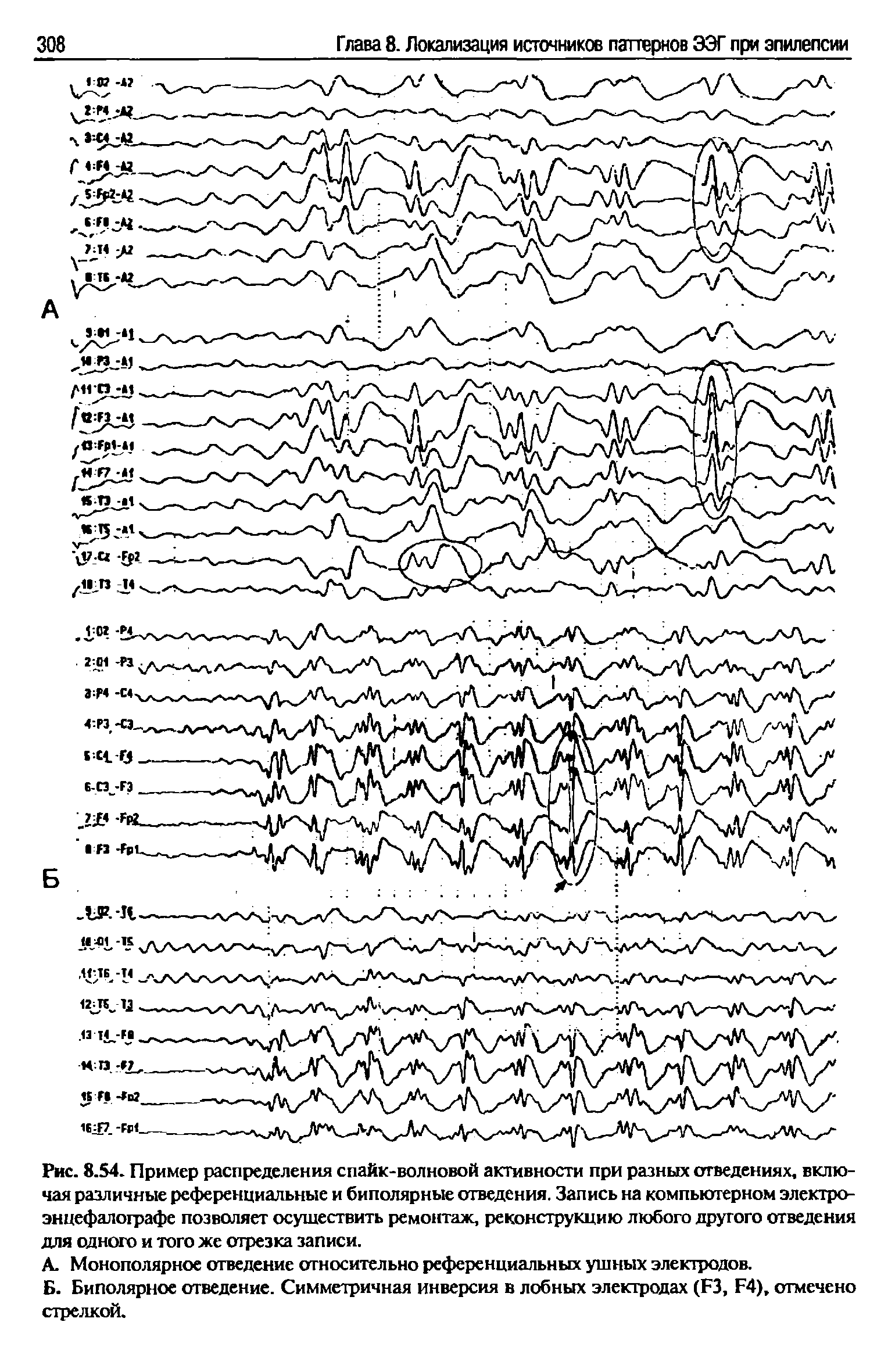 Рис. 8.54. Пример распределения спайк-волновой активности при разных отведениях, включая различные референциальные и биполярные отведения. Запись на компьютерном элекгроэнцефалографе позволяет осуществить ремонтаж, реконструкцию любого другого отведения для одного и того же отрезка записи.