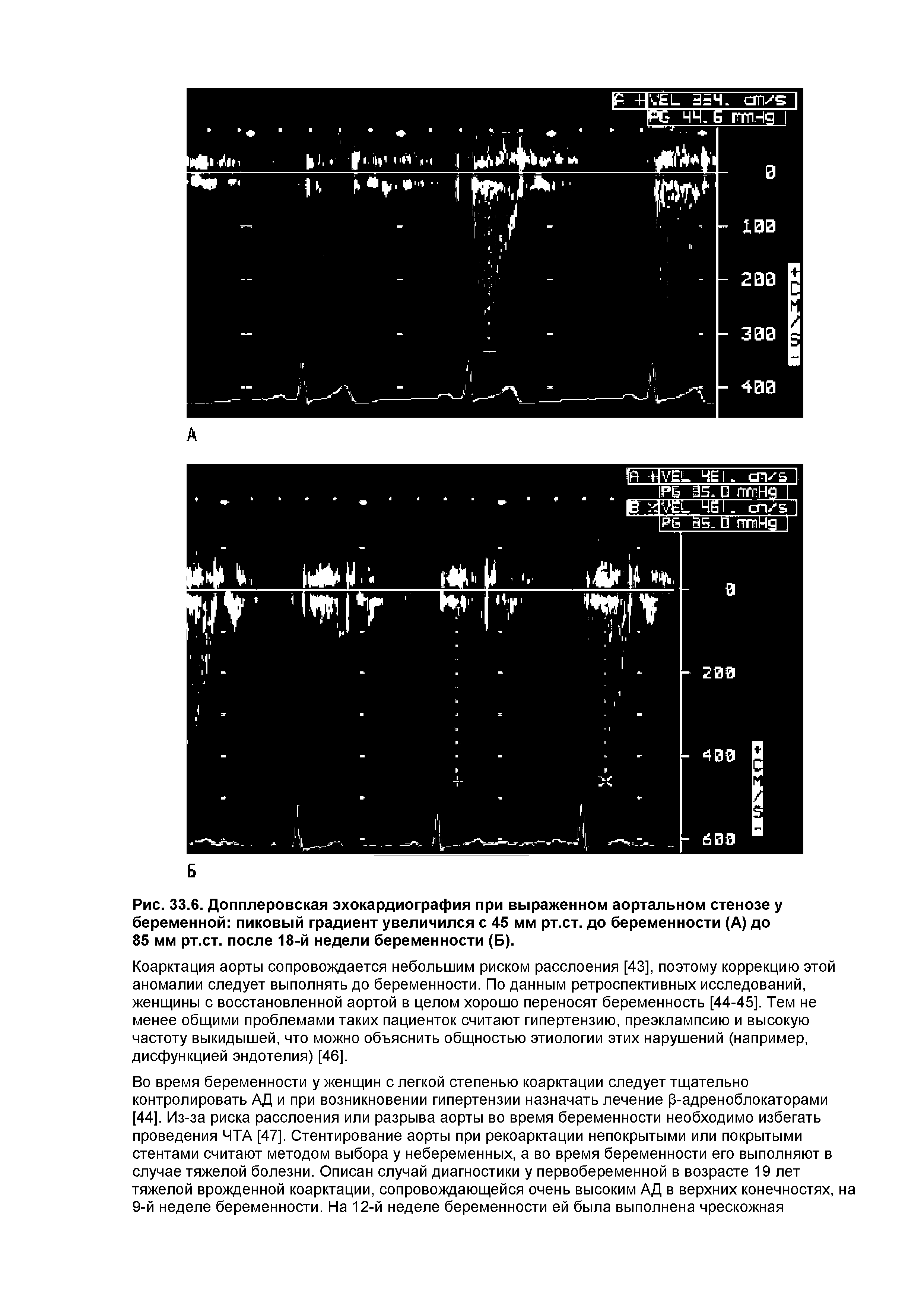 Рис. 33.6. Допплеровская эхокардиография при выраженном аортальном стенозе у беременной пиковый градиент увеличился с 45 мм рт.ст. до беременности (А) до 85 мм рт.ст. после 18-й недели беременности (Б).