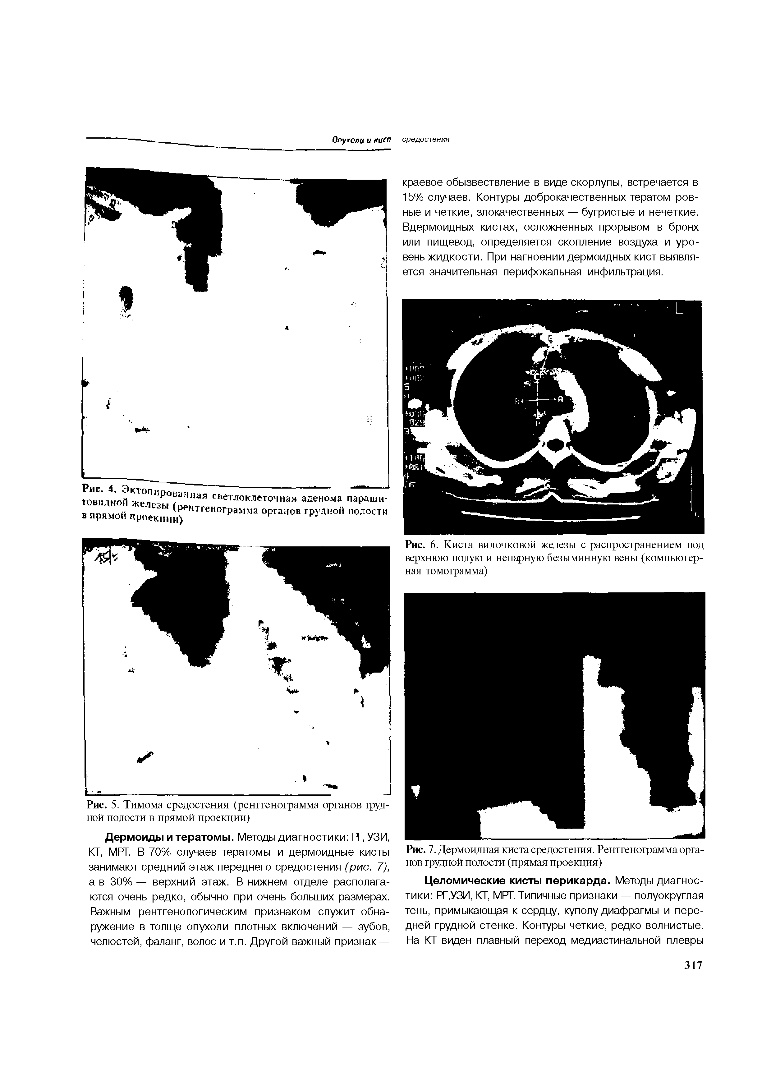 Рис. 7. Дермоидная киста средостения. Рентгенограмма органов грудной полости (прямая проекция)...