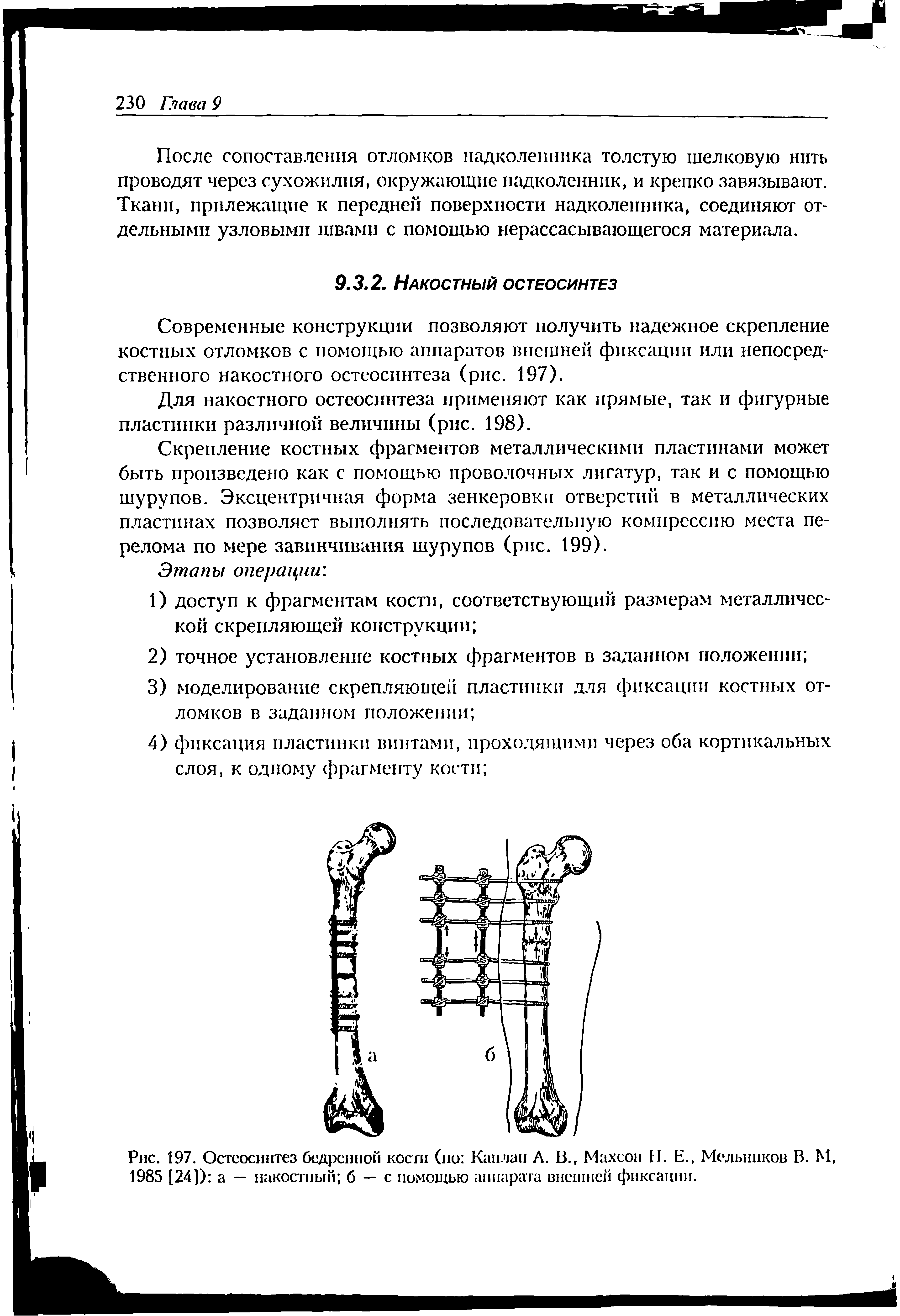 Рис. 197. Остеосинтез бедренной кости (по Каплан А. В., Махсон [I. Е., Мельников В. М, 1985 [24]) а — пакостный б — с помощью аппарата внешней фиксации.