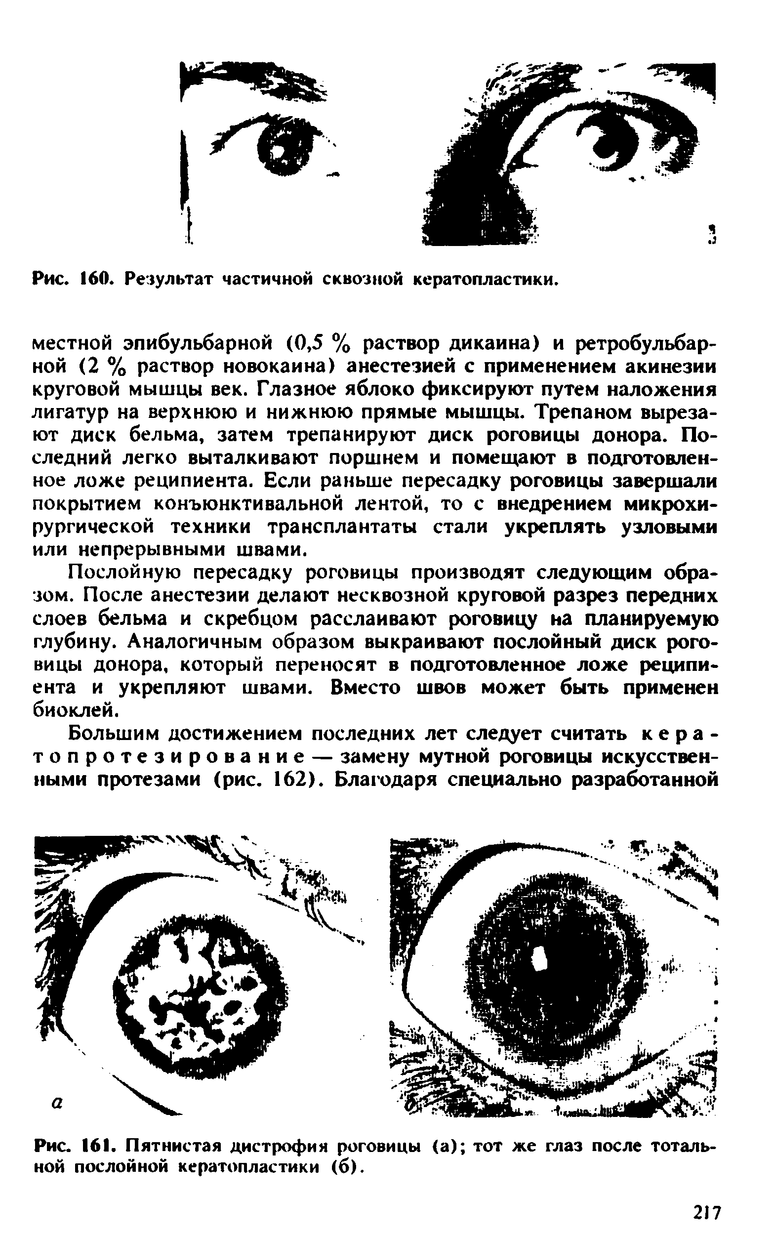 Рис. 161. Пятнистая дистрофия роговицы (а) тот же глаз после тотальной послойной кератопластики (б).