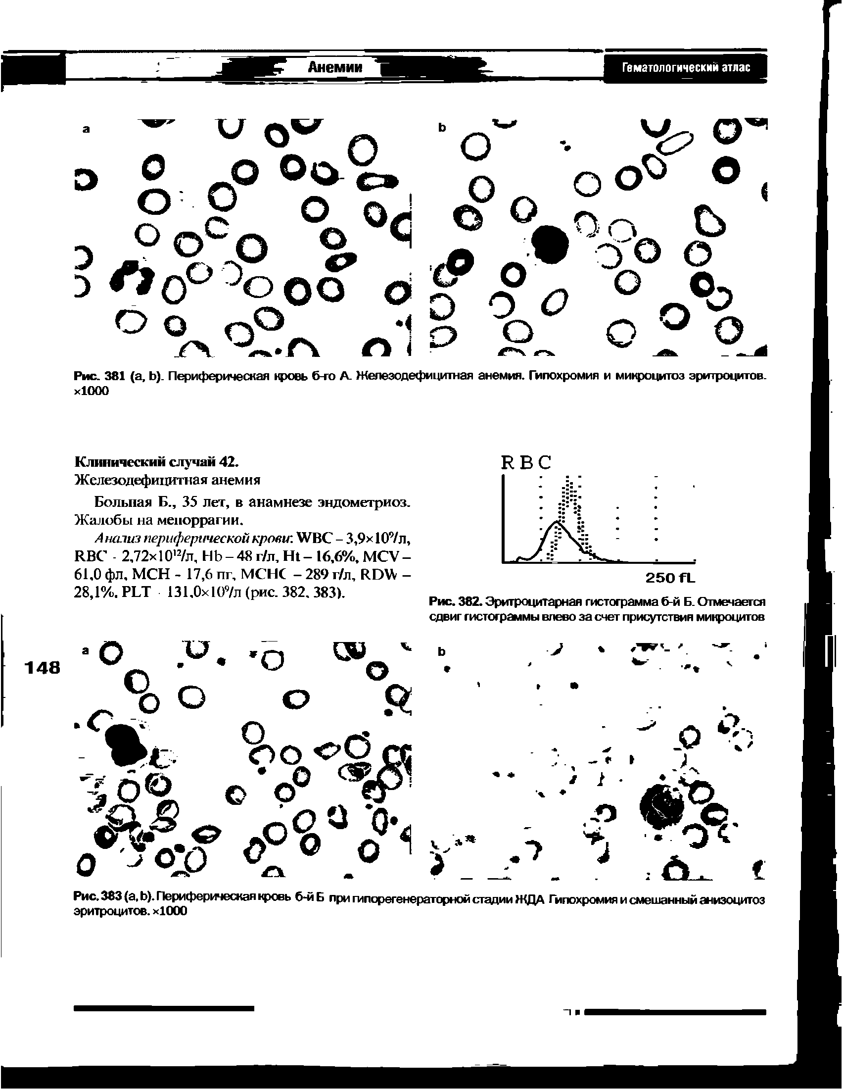 Рис. 382. Эритроцитарная гистограмма б-й Б. Отмечается сдвиг гистограммы влево за счет присутствия микроцитов...