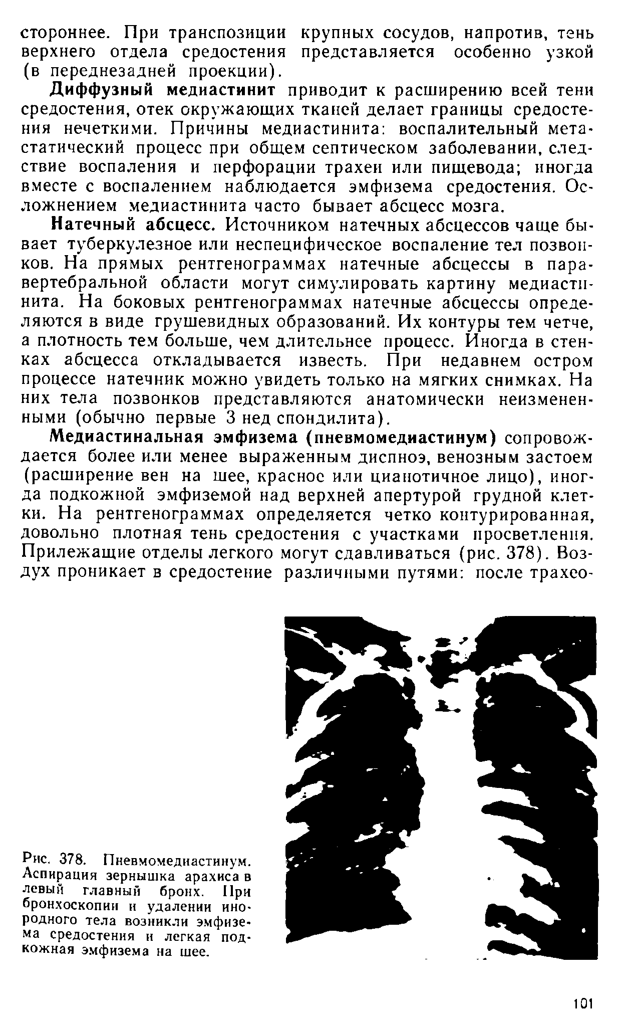 Рис. 378. Пневмомедиастинум. Аспирация зернышка арахиса в левый главный бронх. При бронхоскопии и удалении инородного тела возникли эмфизема средостения и легкая подкожная эмфизема на шее.