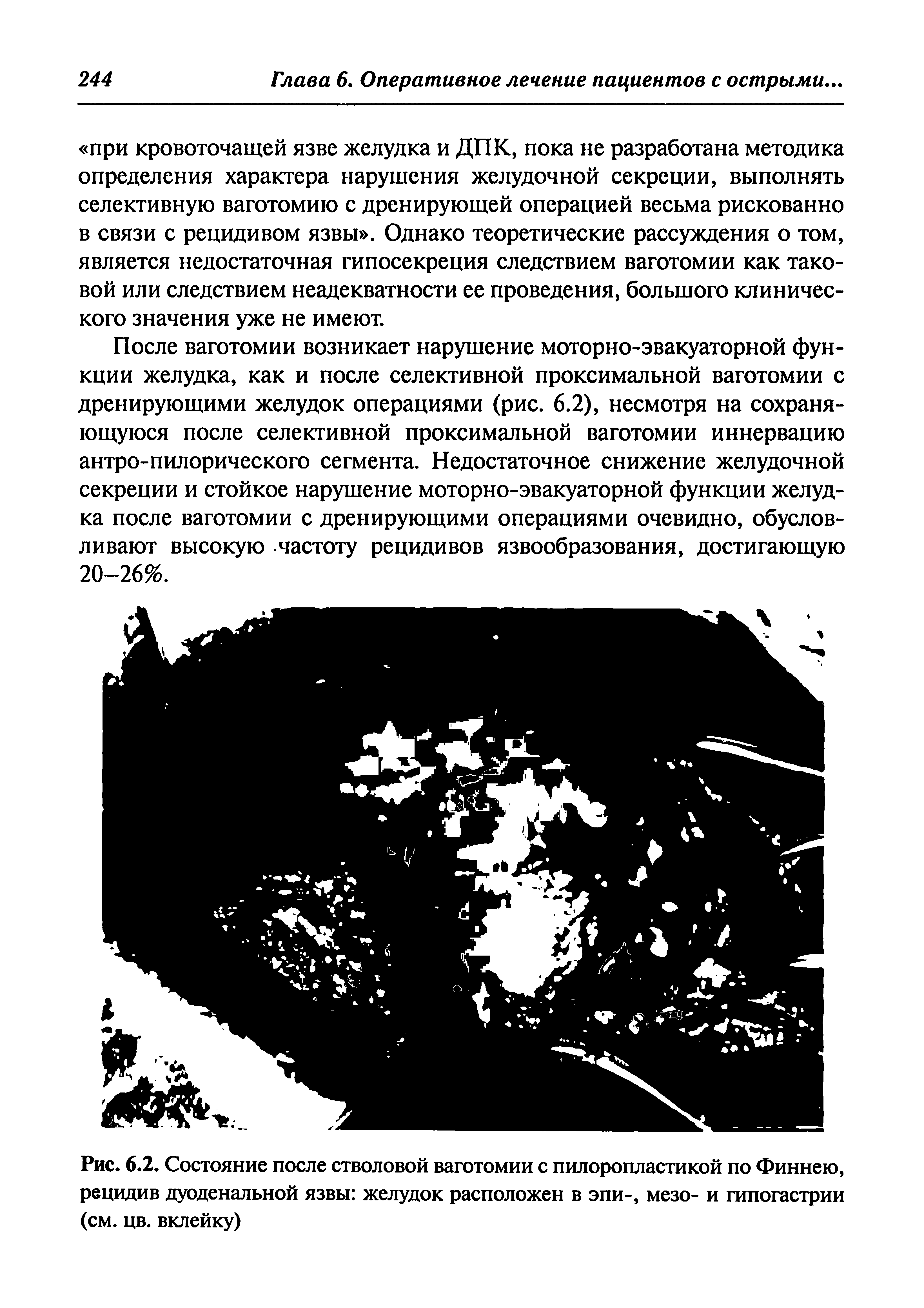 Рис. 6.2. Состояние после стволовой ваготомии с пилоропластикой по Финнею, рецидив дуоденальной язвы желудок расположен в эпи-, мезо- и гипогастрии (см. цв. вклейку)...