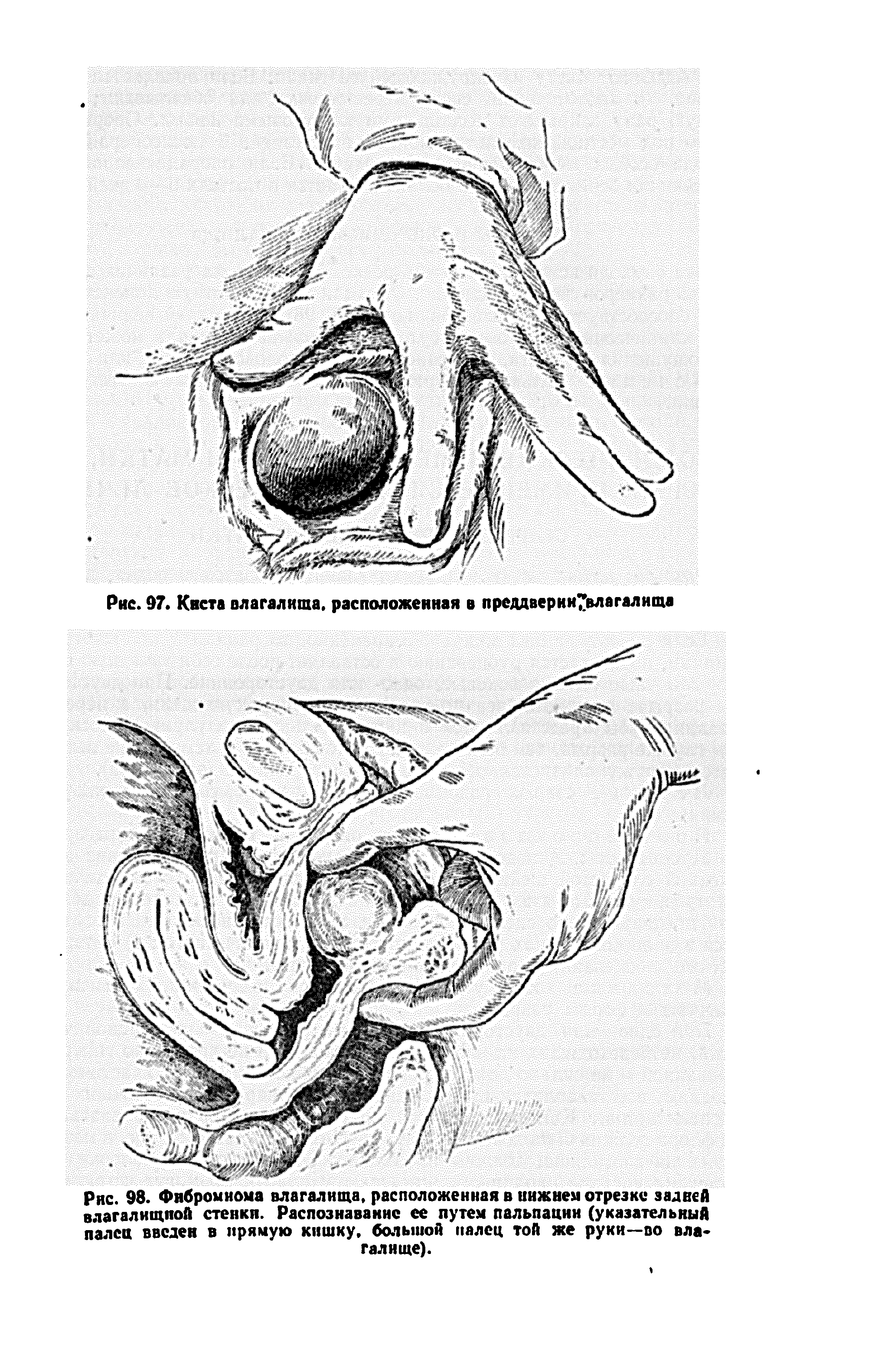 Рис. 98. Фибромиома влагалища, расположенная в нижнем отрезке задней влагалищной стенки. Распознавание ее путем пальпации (указательный палец введен в прямую кишку, большой палец той же руки—во влагалище).