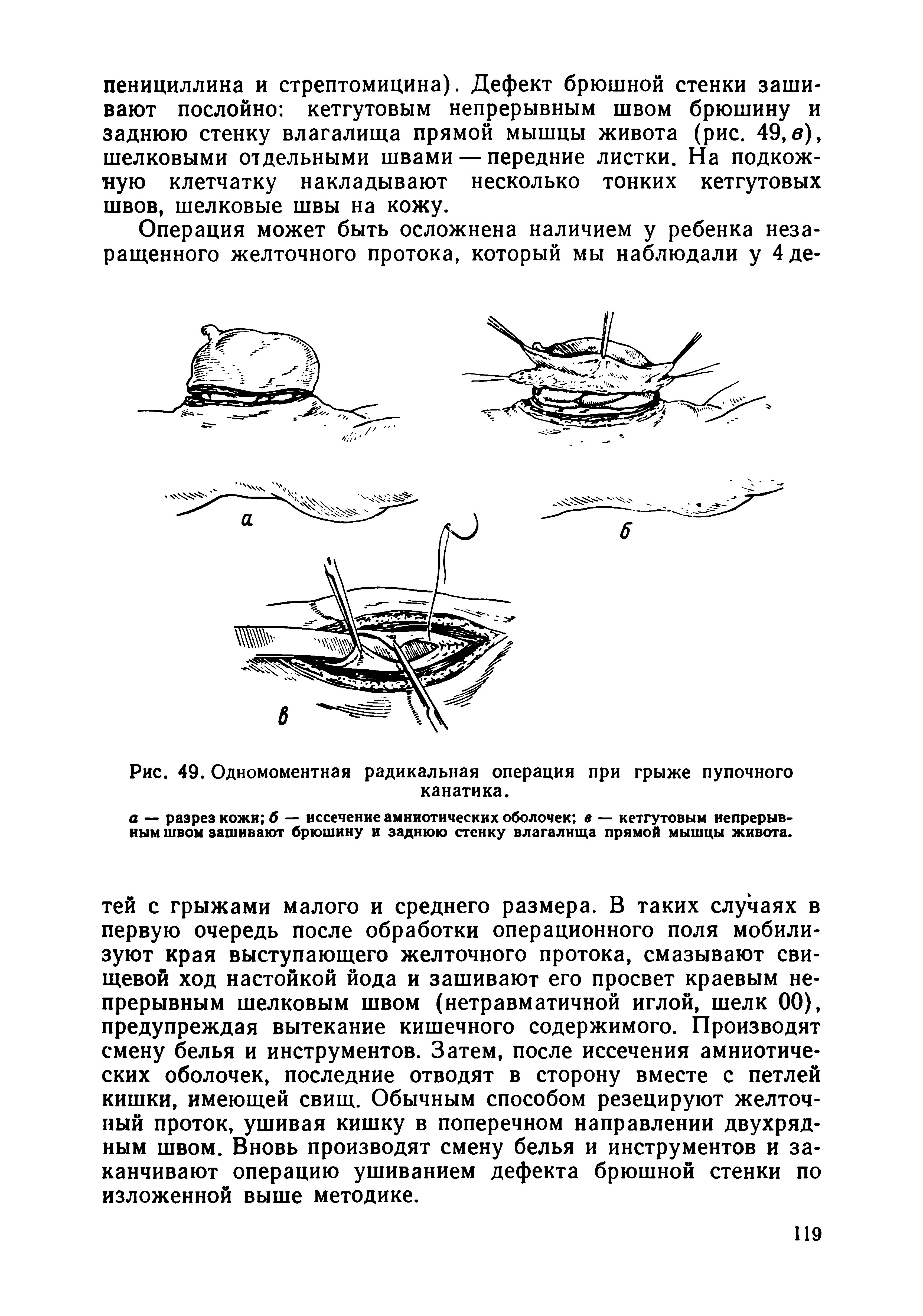 Рис. 49. Одномоментная радикальная операция при грыже пупочного канатика.