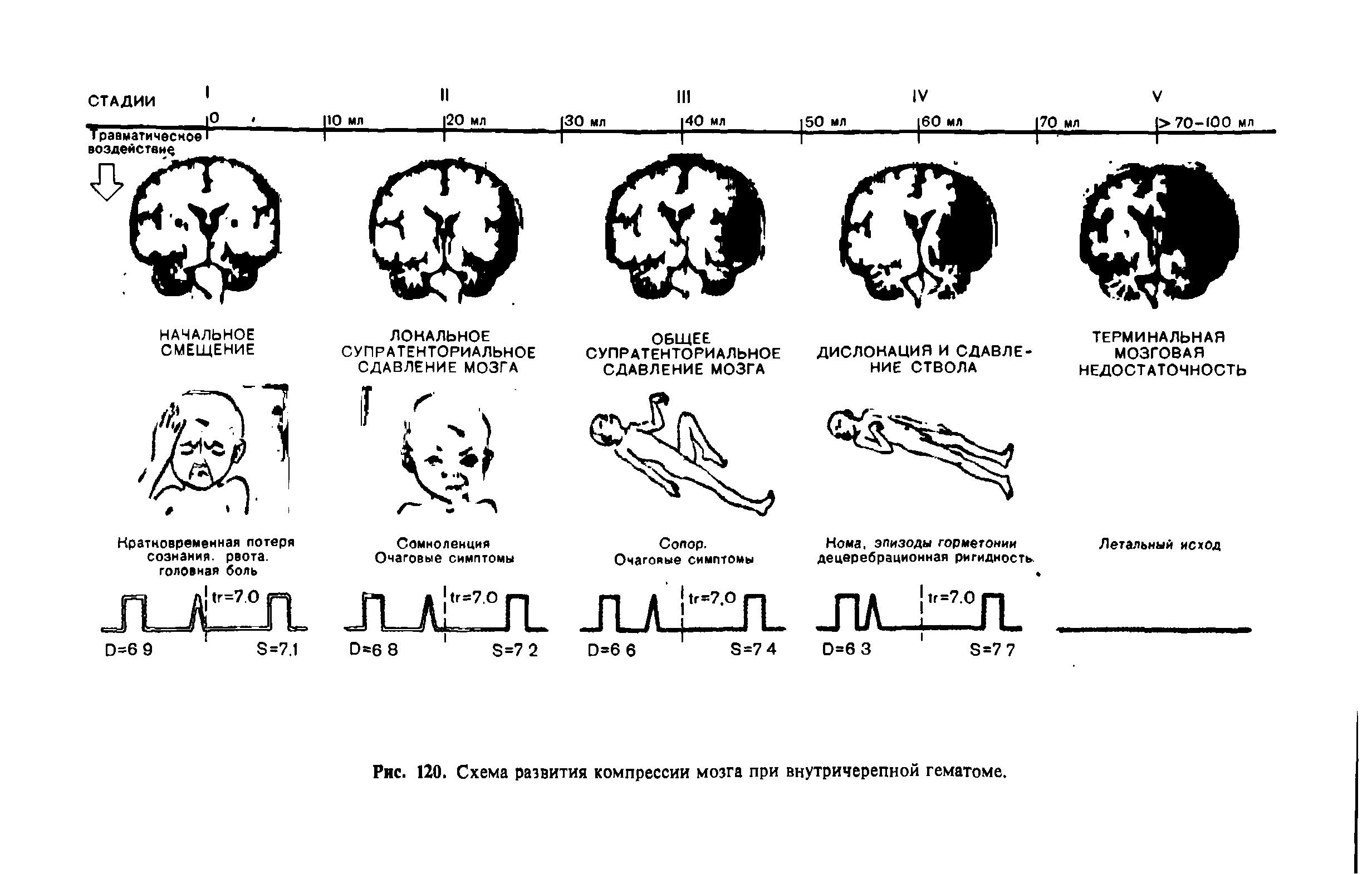 Рис. 120. Схема развития компрессии мозга при внутричерепной гематоме.