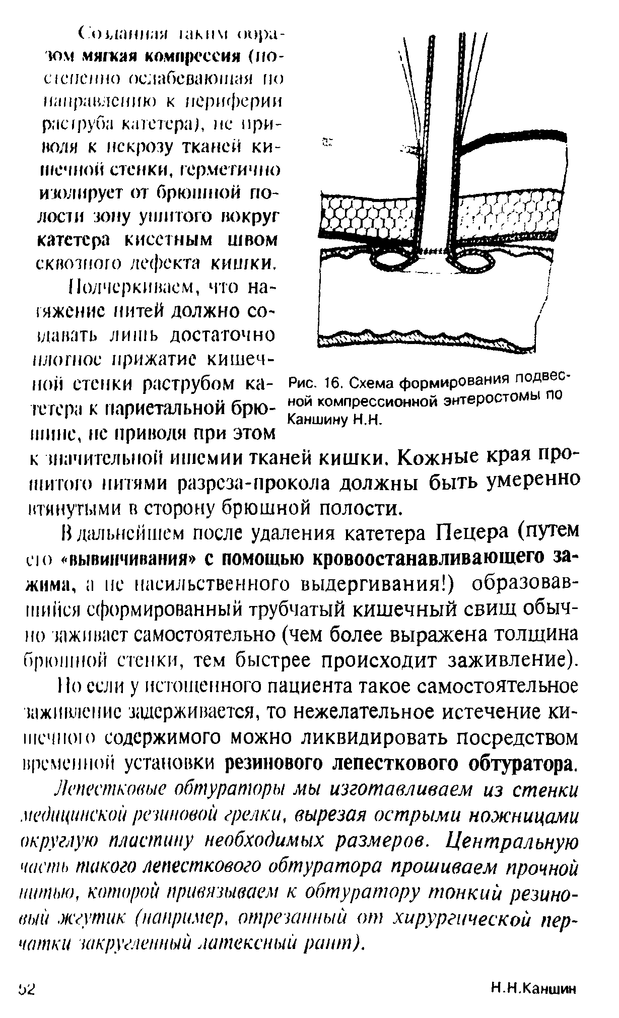 Рис. 16. Схема формирования подвесной компрессионной энтеростомы по Каншину Н.Н.