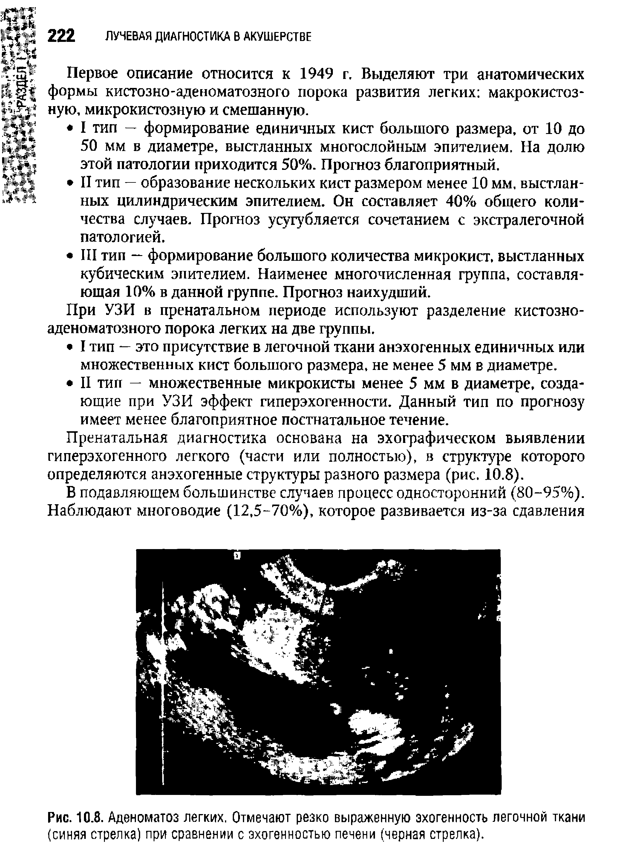 Рис. 10.8. Аденоматоз легких. Отмечают резко выраженную эхогенность легочной ткани (синяя стрелка) при сравнении с эхогенностью печени (черная стрелка).