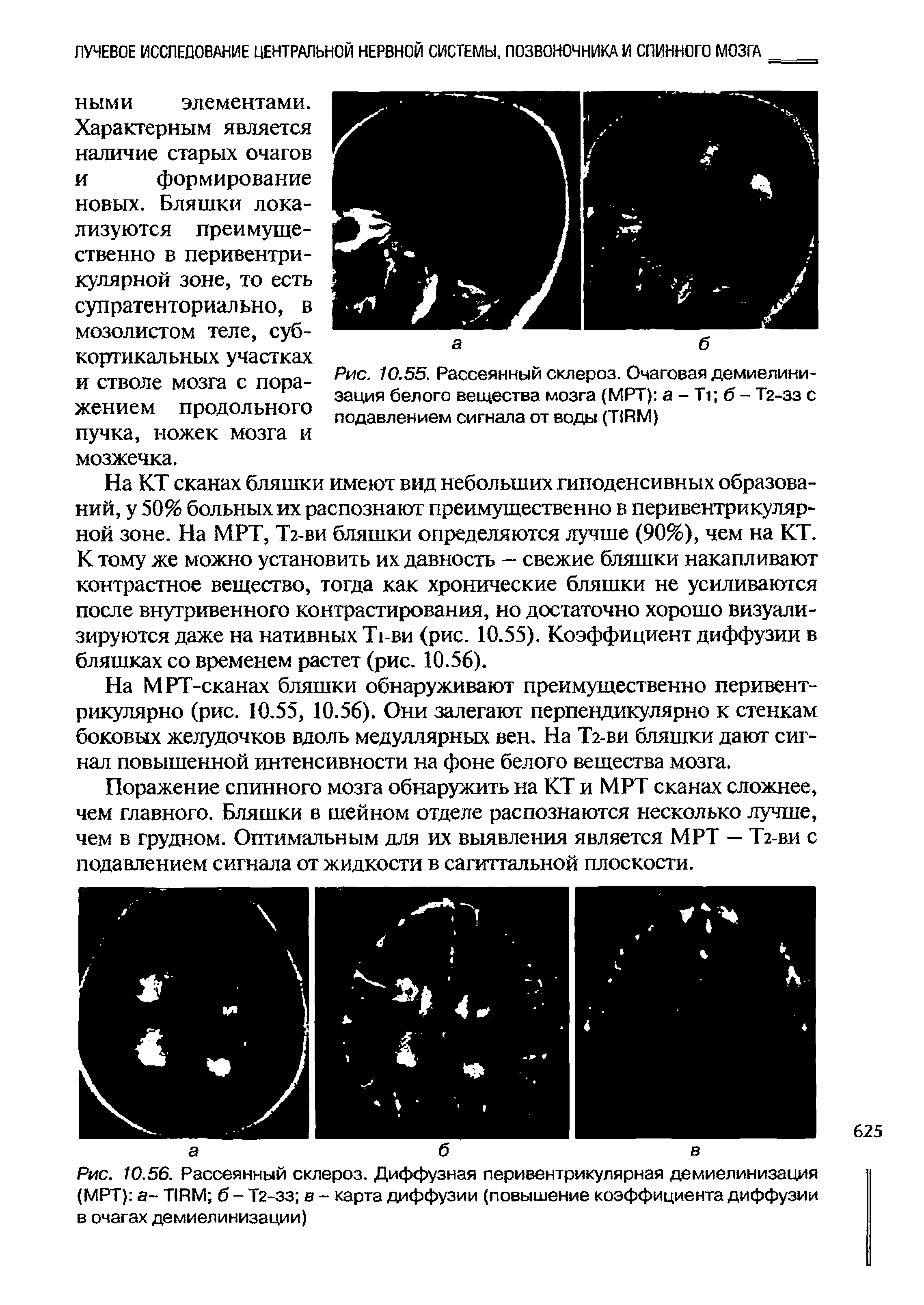 Рис. 10.56. Рассеянный склероз. Диффузная перивентрикулярная демиелинизация (МРТ) - TIRM б - Т2-зз в - карта диффузии (повышение коэффициента диффузии в очагах демиелинизации)...