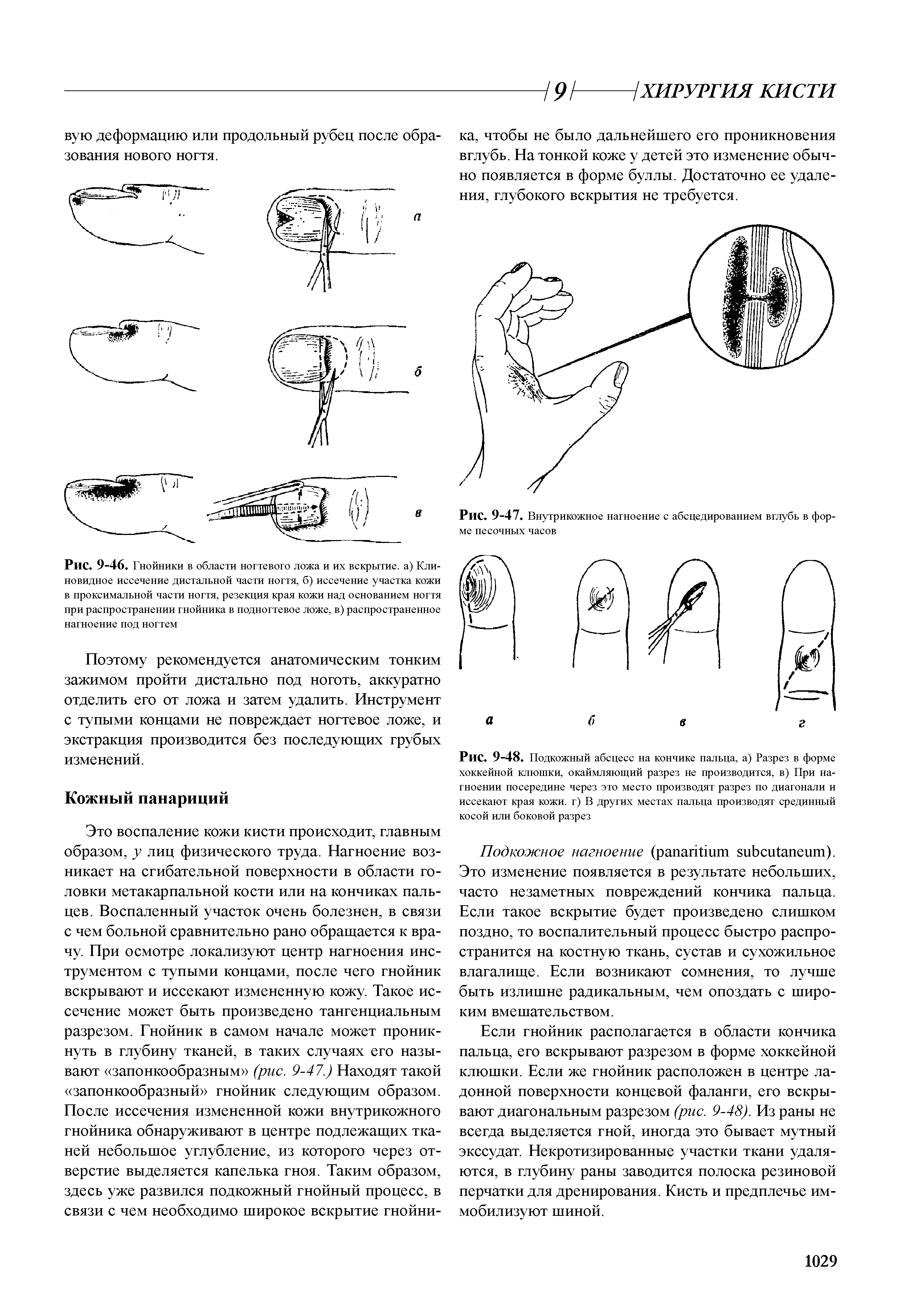 Рис. 9-46. Гнойники в области ногтевого ложа и их вскрытие, а) Клиновидное иссечение дистальной части ногтя, б) иссечение участка кожи в проксимальной части ногтя, резекция края кожи над основанием ногтя при распространении гнойника в подногтевое ложе, в) распространенное нагноение под ногтем...