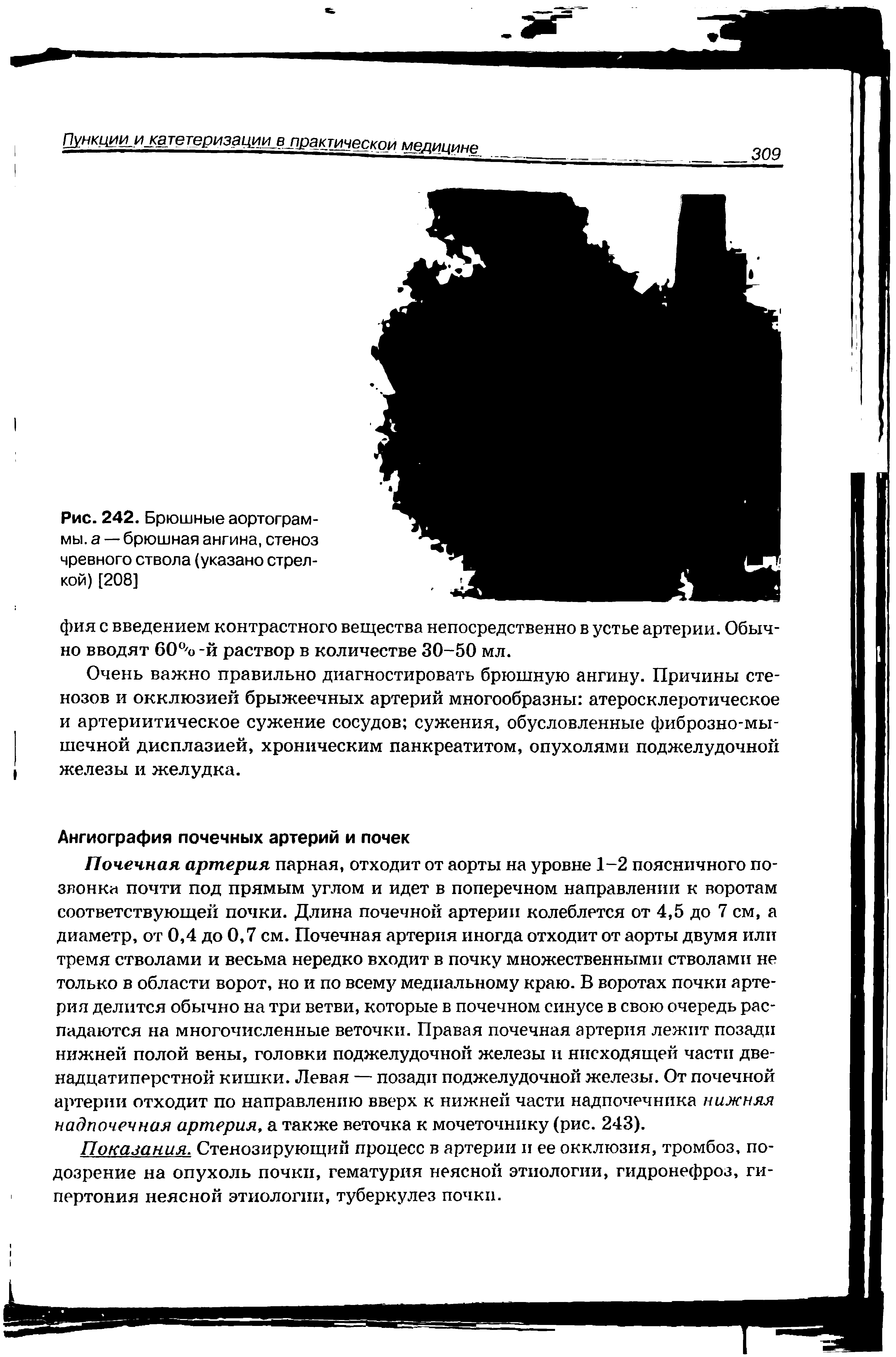 Рис. 242. Брюшные аортограм-мы. а — брюшная ангина, стеноз чревного ствола (указано стрелкой) [208]...