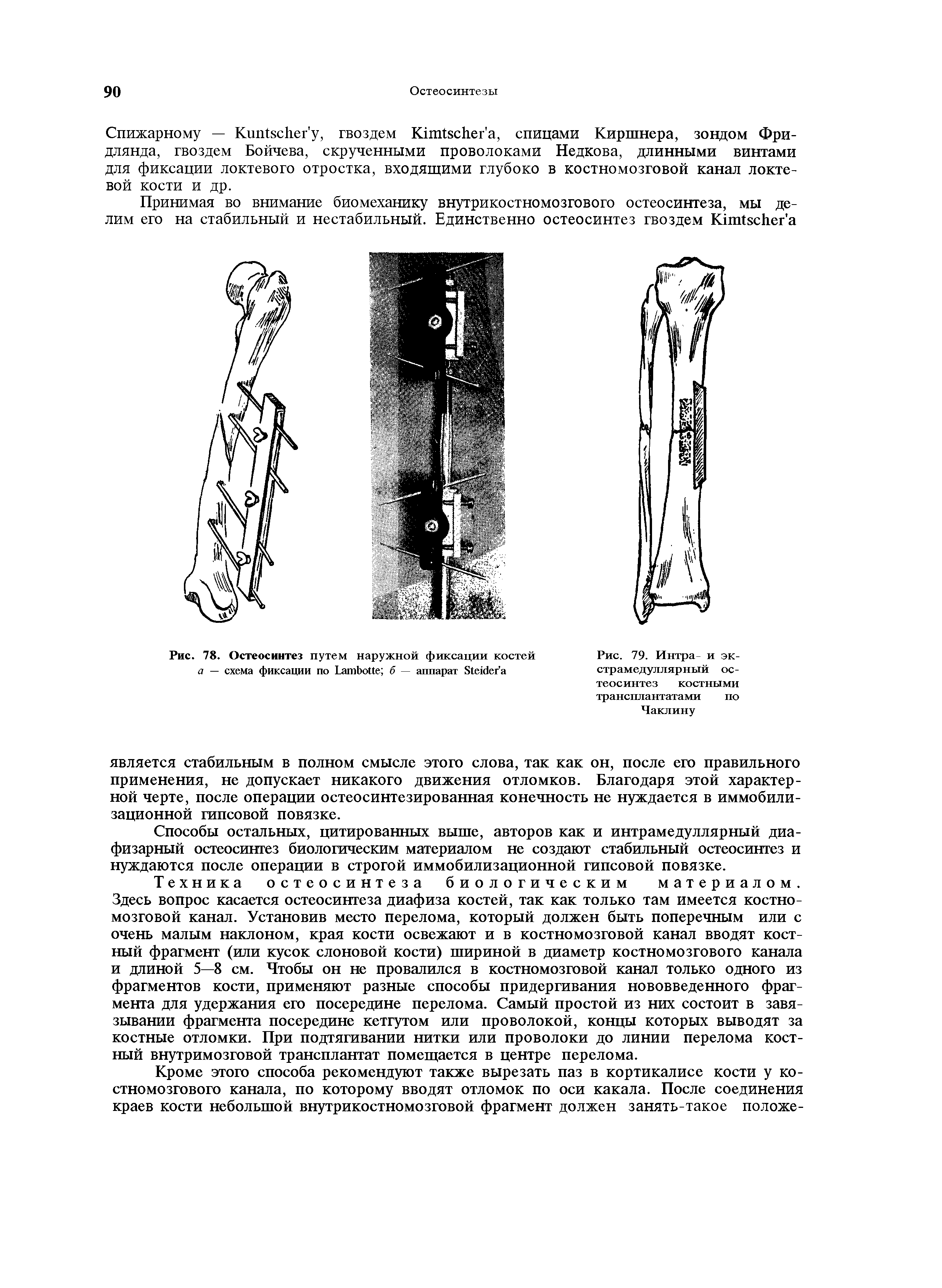 Рис. 79. Интра- и экстрамедуллярный остеосинтез костными трансплантатами по Чаклину...