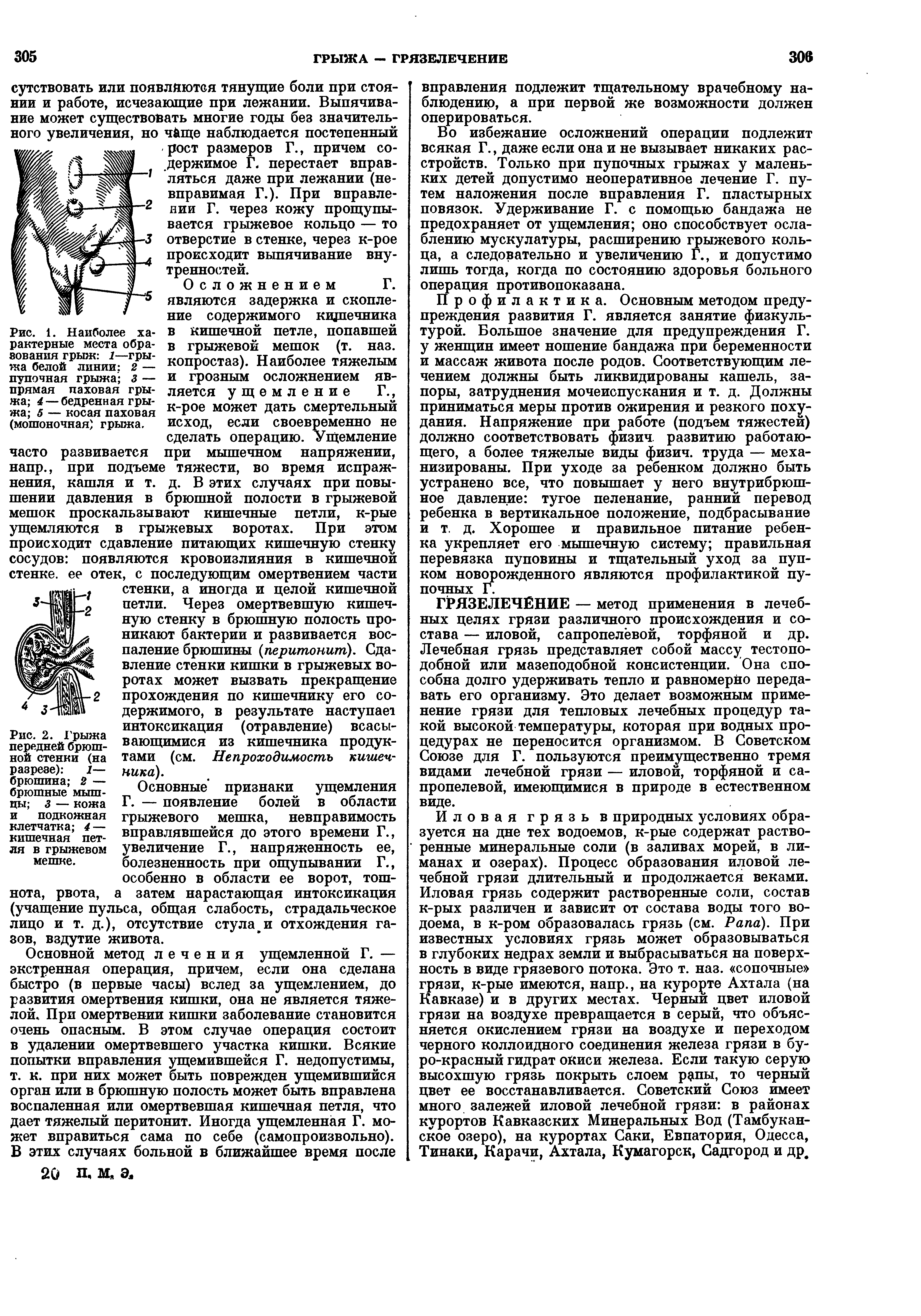 Рис. 1. Наиболее характерные места образования грыж 1—грыжа белой линии 2 — пупочная грыжа 3 — прямая паховая грыжа 4— бедренная грыжа 5 — косая паховая (мошоночная) грыжа.