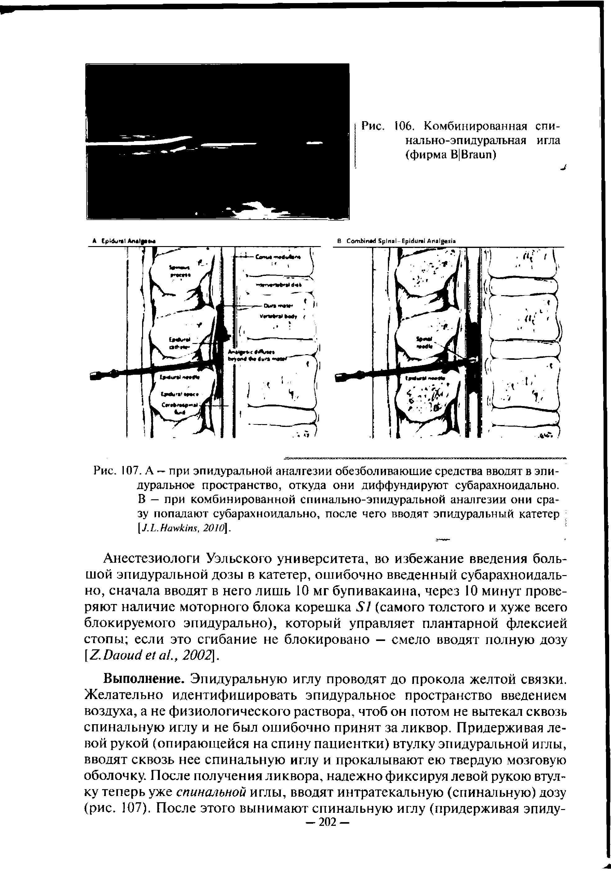 Рис. 107. А — при эпидуральной аналгезии обезболивающие средства вводят в эпидуральное пространство, откуда они диффундируют субарахноидально. В — при комбинированной спинально-эпидуральной аналгезии они сразу попадают субарахноидально, после чего вводят эпидуральный катетер [ J. L. H , 2070].