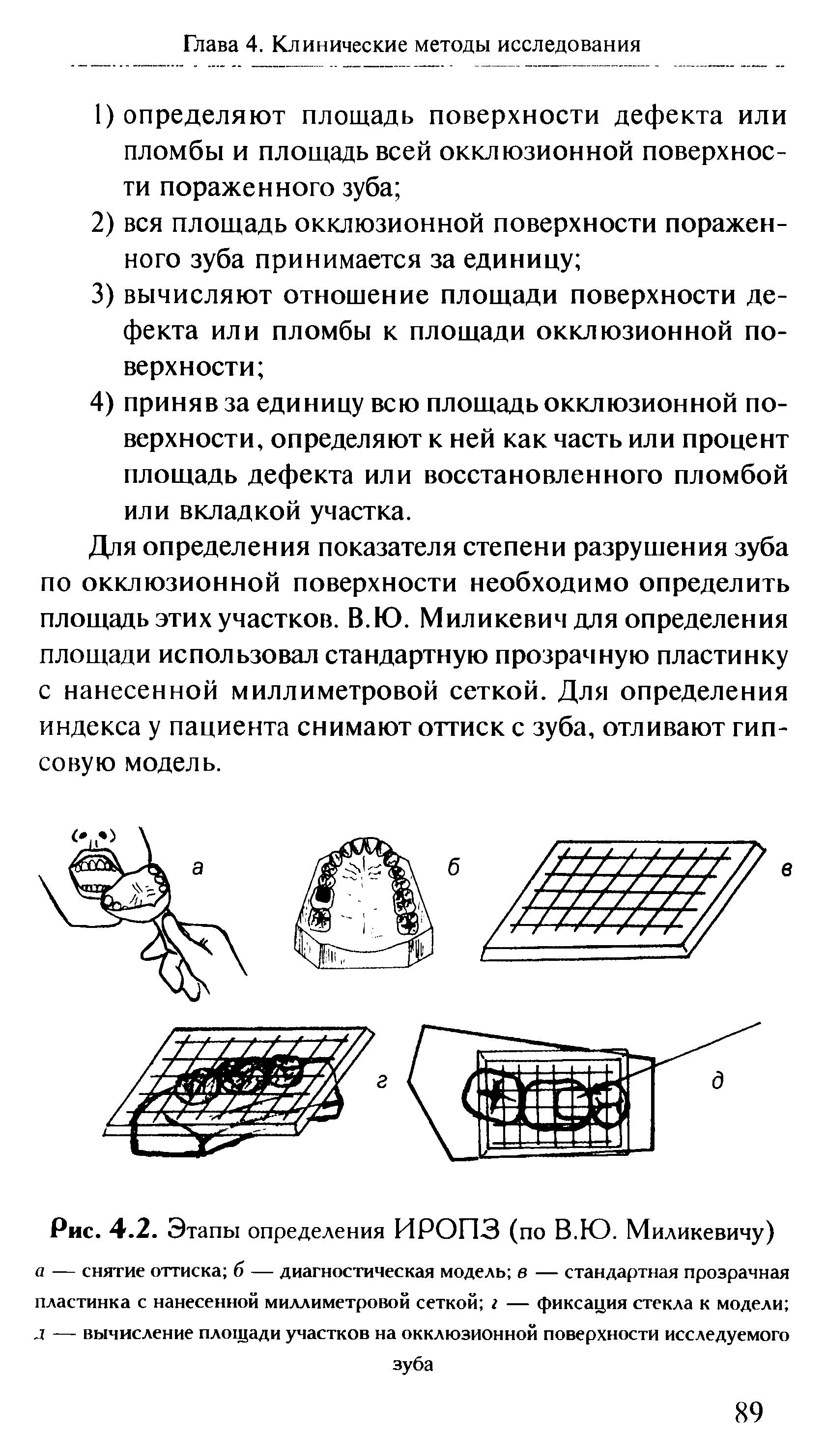 Рис. 4.2. Этапы определения ИРОПЗ (по В.Ю. Миликевичу) а — снятие оттиска б — диагностическая модель в — стандартная прозрачная пластинка с нанесенной миллиметровой сеткой г — фиксация стекла к модели д — вычисление площади участков на окклюзионной поверхности исследуемого зуба...