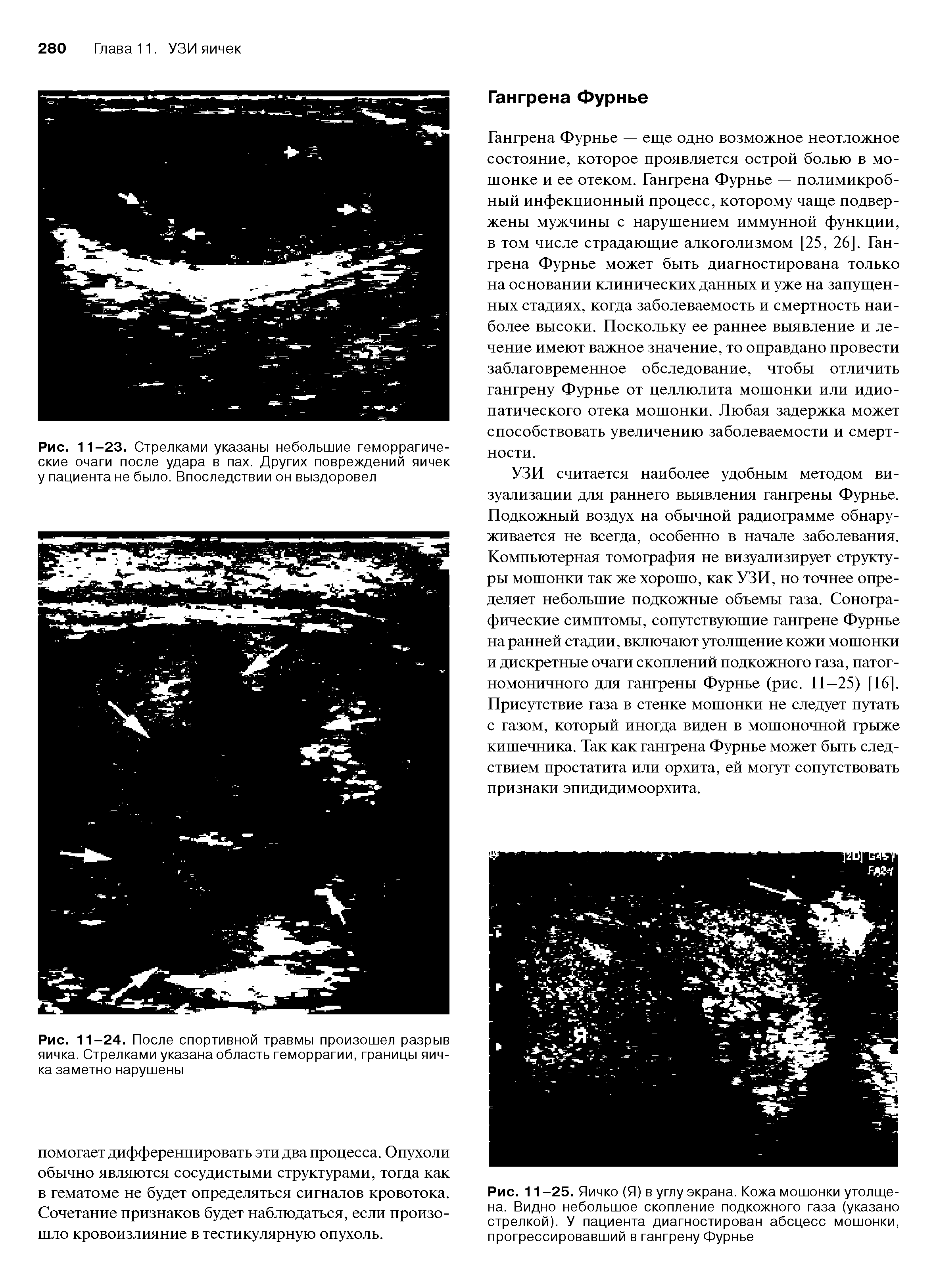 Рис. 11 -25. Яичко (Я) в углу экрана. Кожа мошонки утолщена. Видно небольшое скопление подкожного газа (указано стрелкой). У пациента диагностирован абсцесс мошонки, прогрессировавший в гангрену Фурнье...