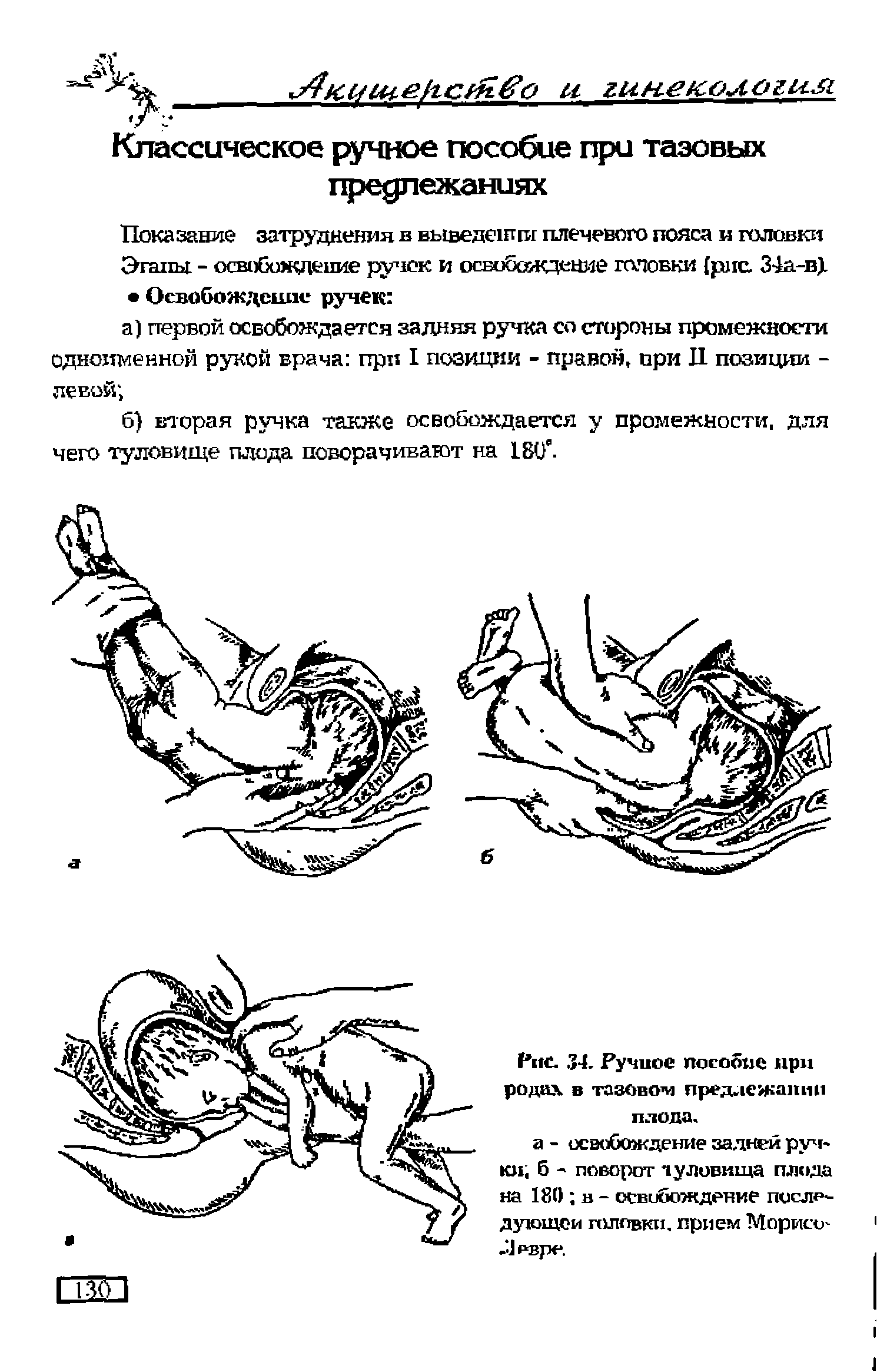 Рис. 34. Ручное пособие при родах в тазовом предлежании плода.