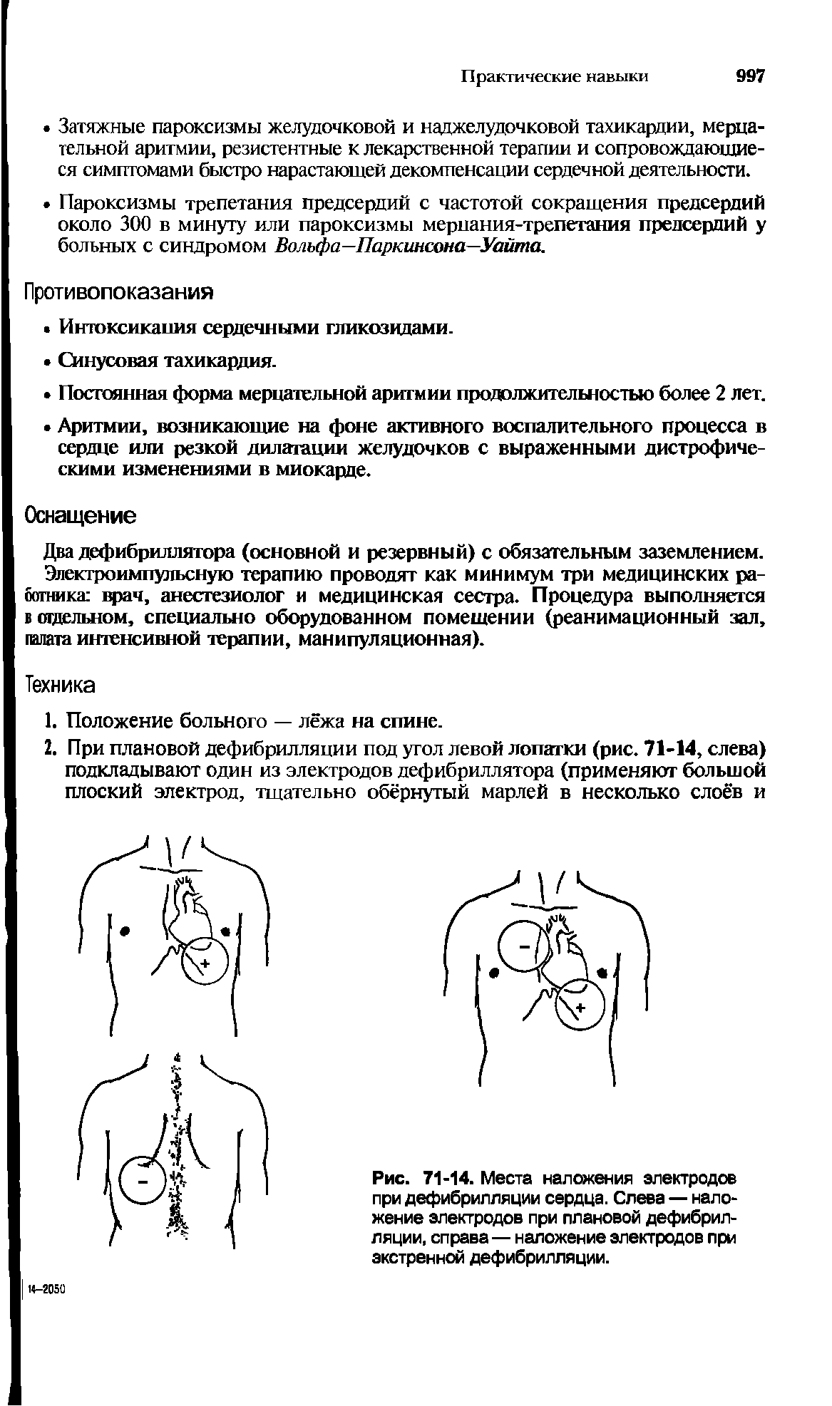 Рис. 71-14. Места наложения электродов при дефибрилляции сердца. Слева — наложение электродов при плановой дефибрилляции, справа—наложение электродов при экстренной дефибрилляции.