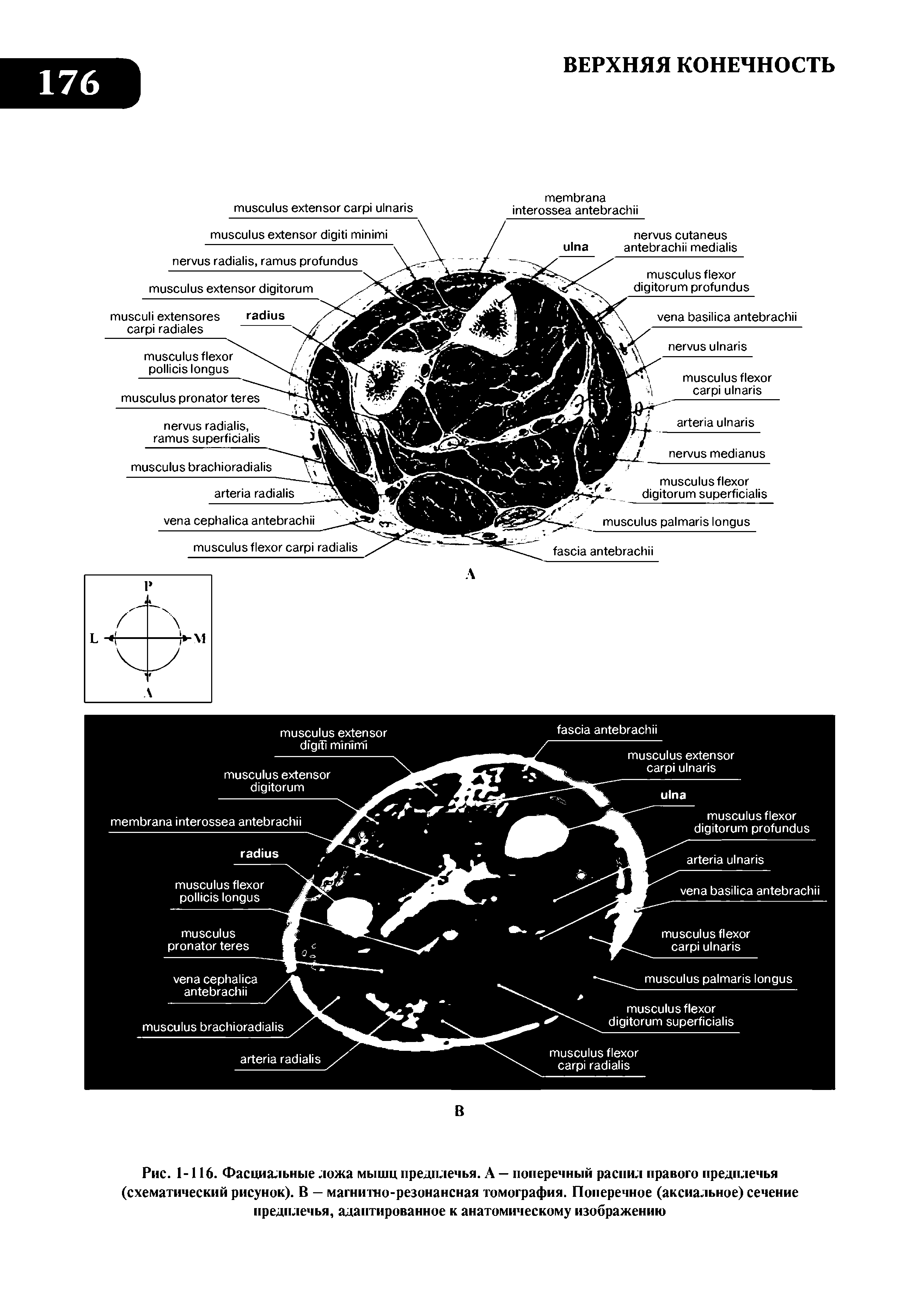 Рис. 1-116. Фасциальные ложа мышц предплечья. А — поперечный распил правого предплечья (схематический рисунок). В — магнитно-резонансная томография. Поперечное (аксиальное) сечение предплечья, адаптированное к анатомическому изображению...